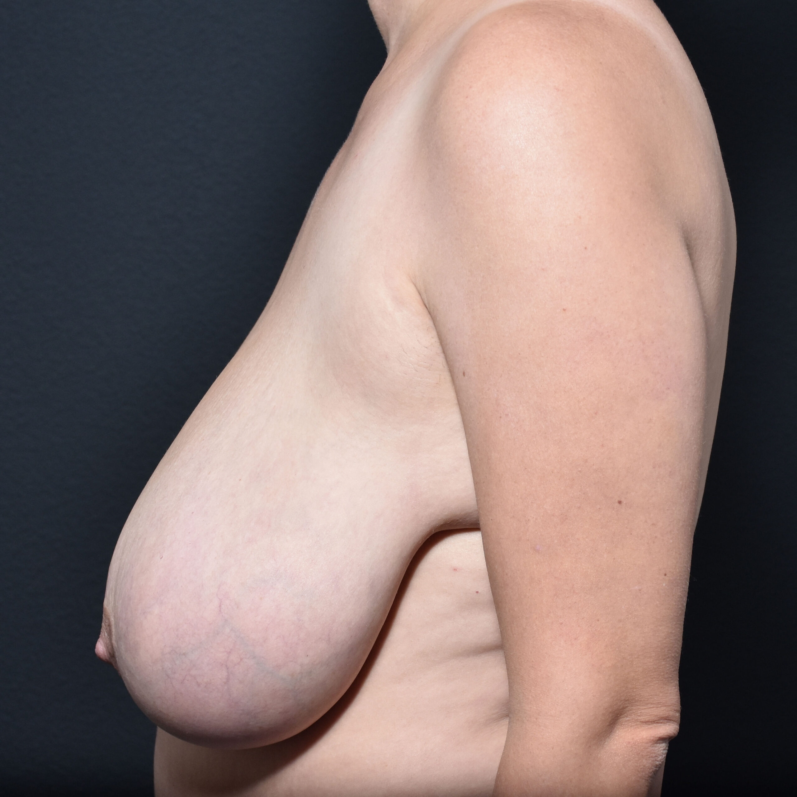 Case--4537 | Before Breast Reduction 3