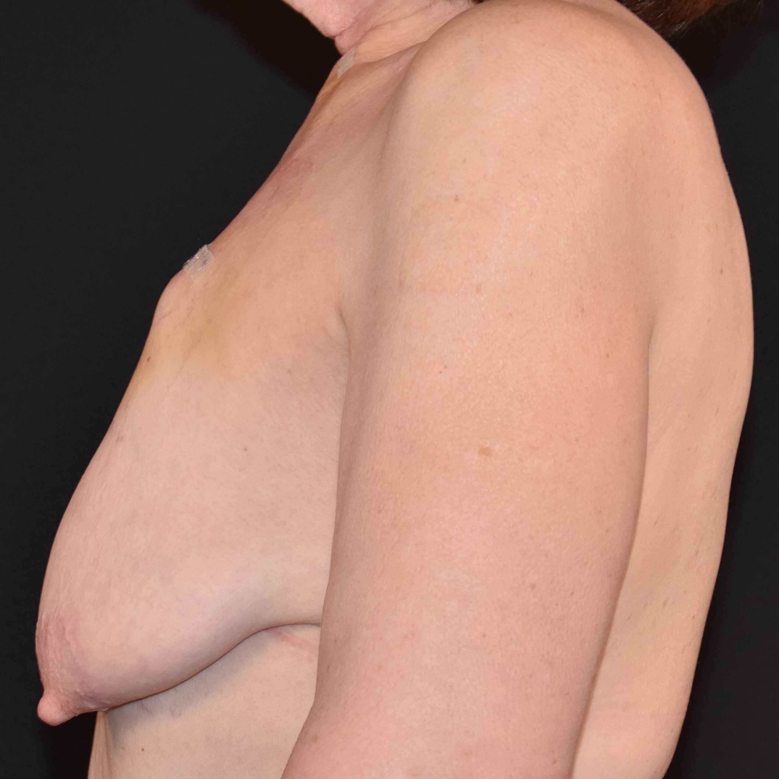 Case--4923 | Before Breast Reconstruction 2