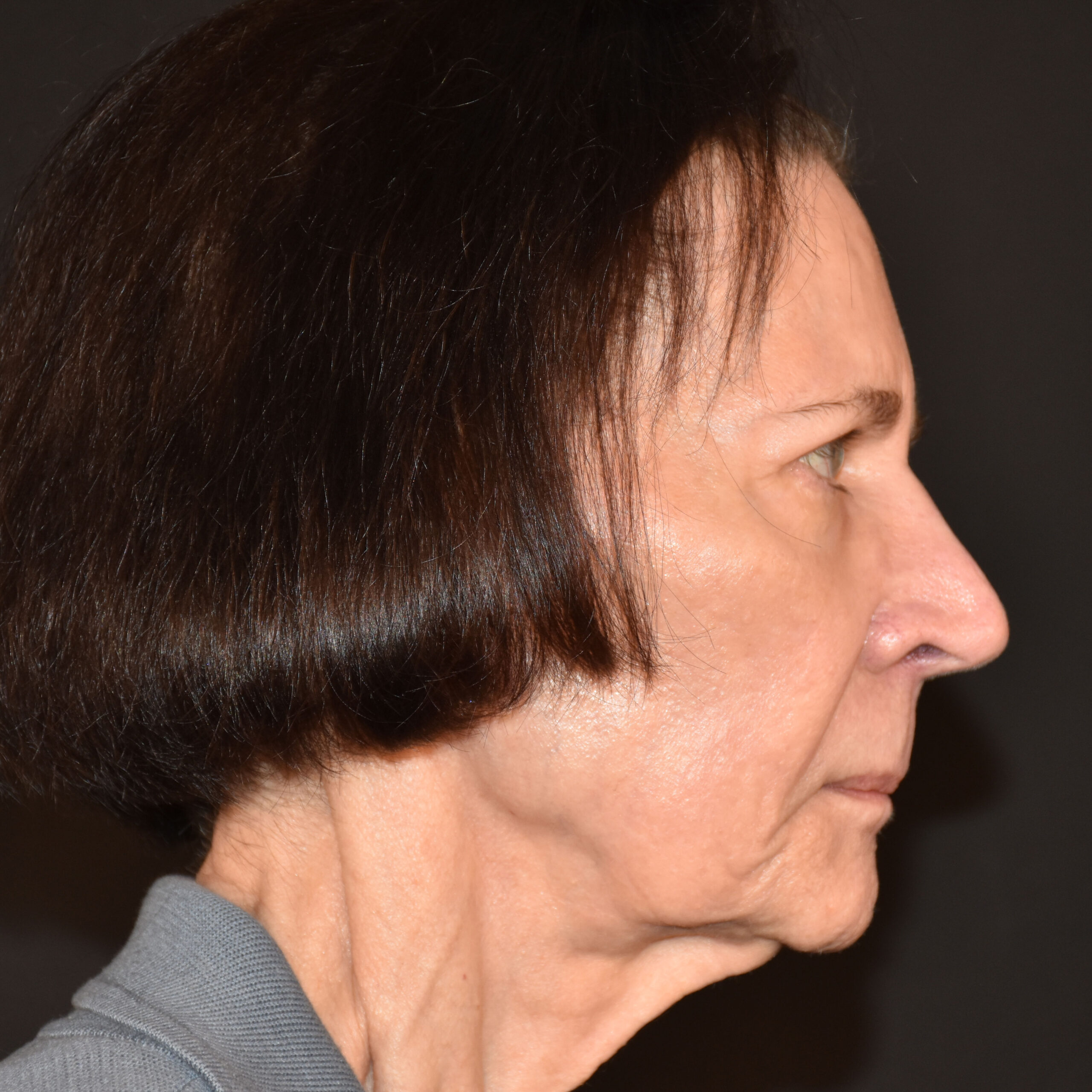 Case--1382 | Before Facial Fillers 2