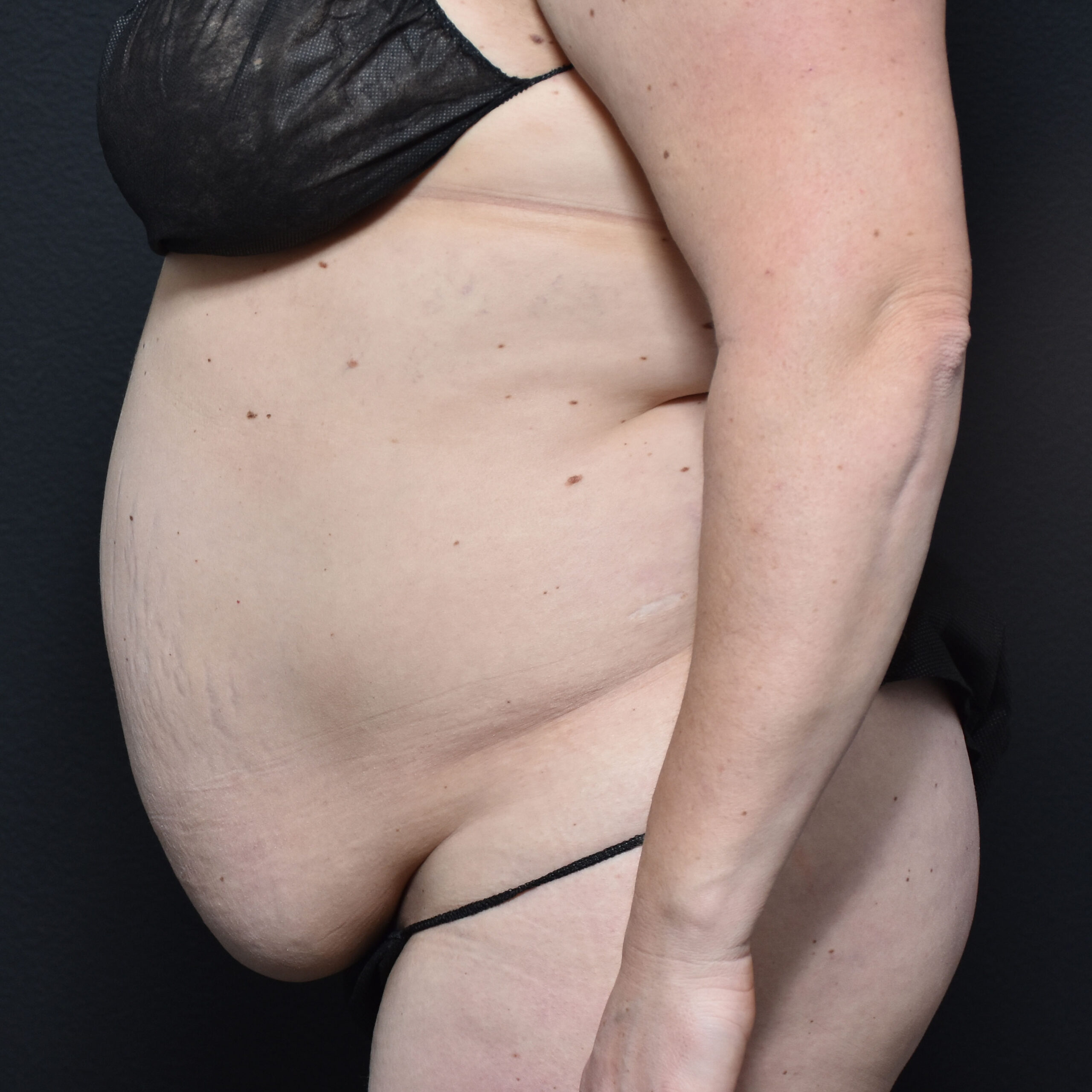 Case--2409 | Before Tummy Tuck 3