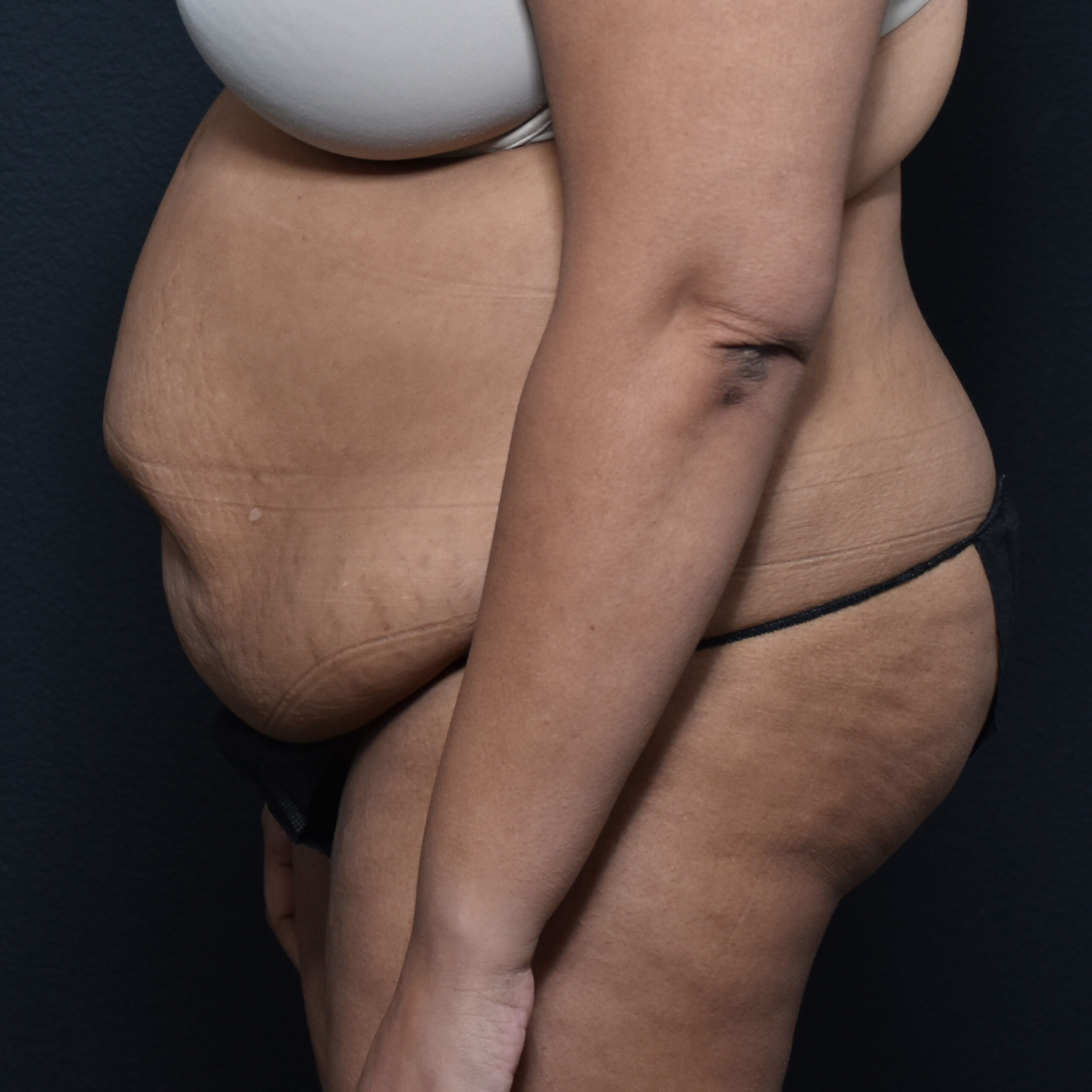 Case--8957 | Before Tummy Tuck 5