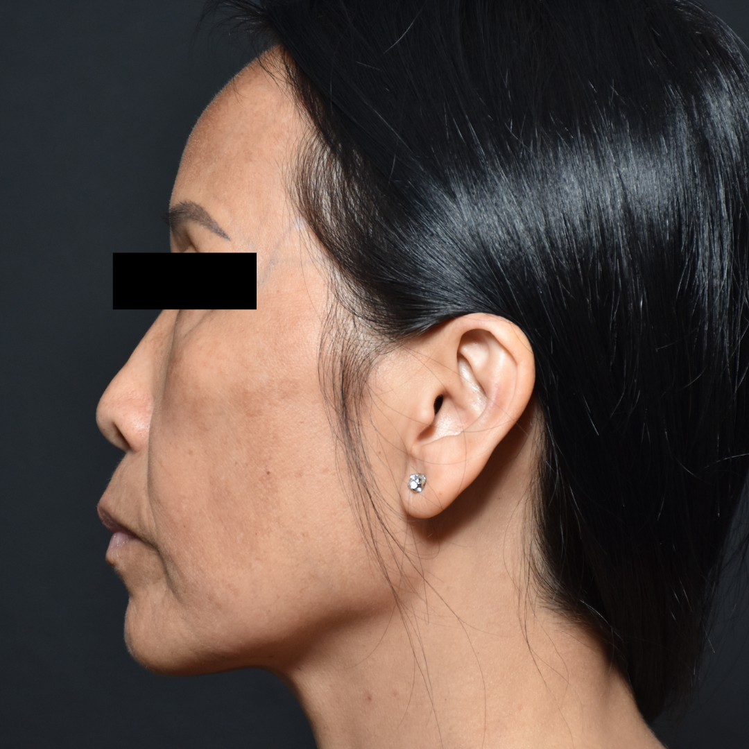 Case--7237 | Before Facials and Peels 3