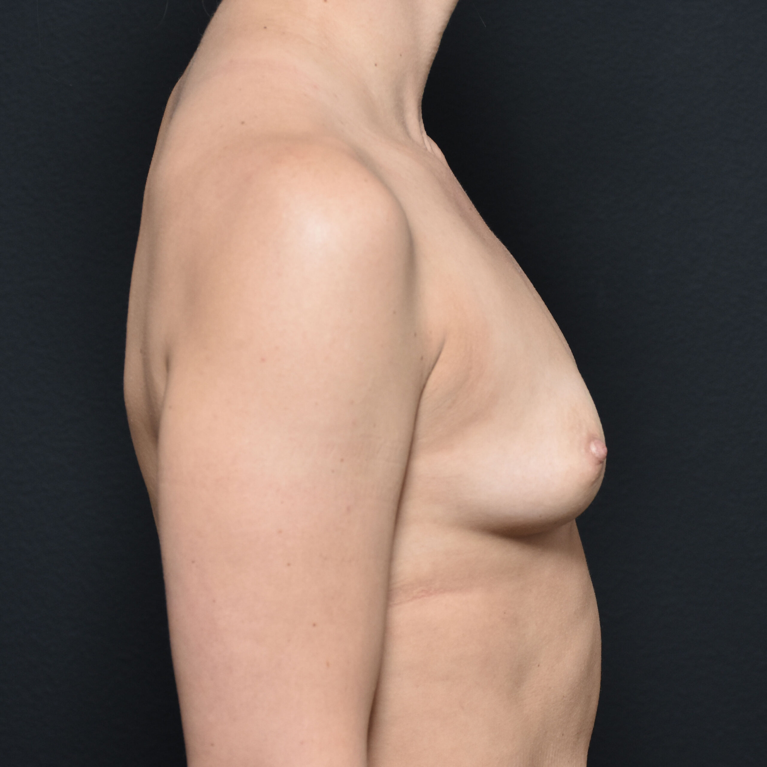 Case--6628 | Before Breast Augmentation 3
