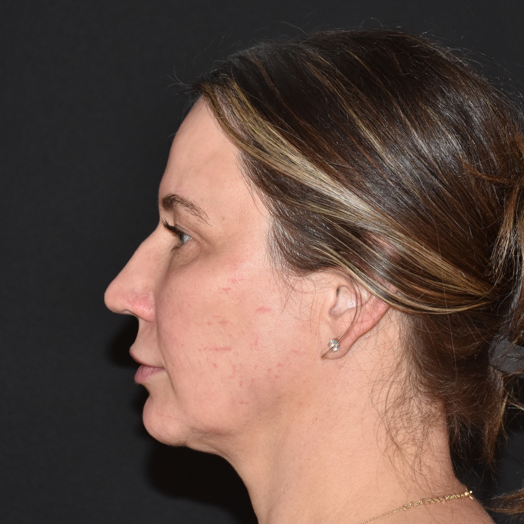 Case--2367 | Before Face Treatments
