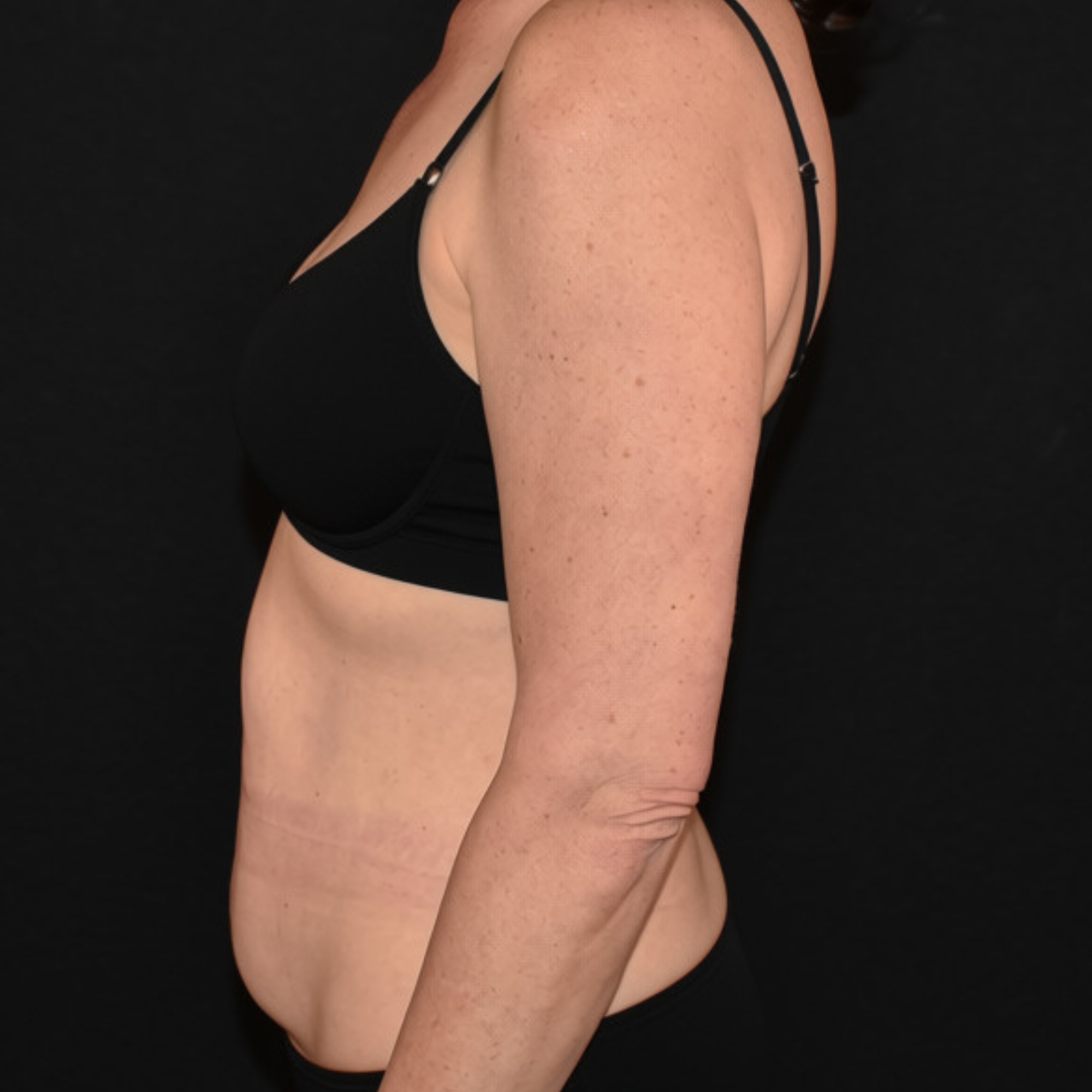 Case--3430 | Before Tummy Tuck 3
