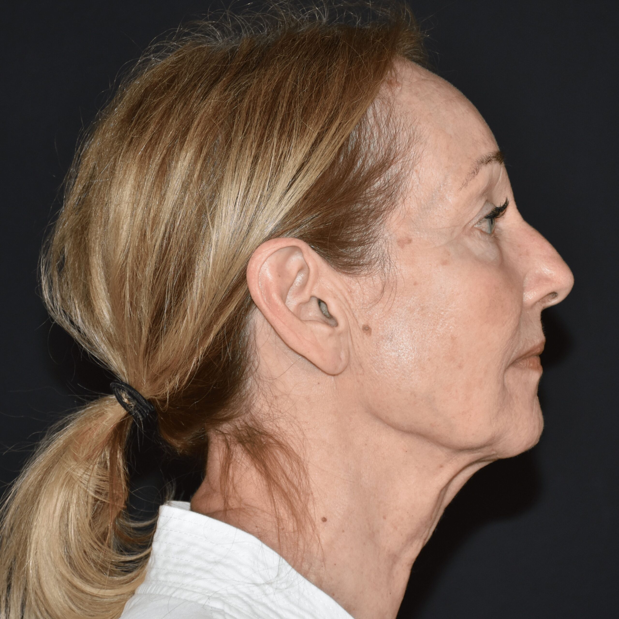 Case--3488 | Before Facelift and Neck Lift 3