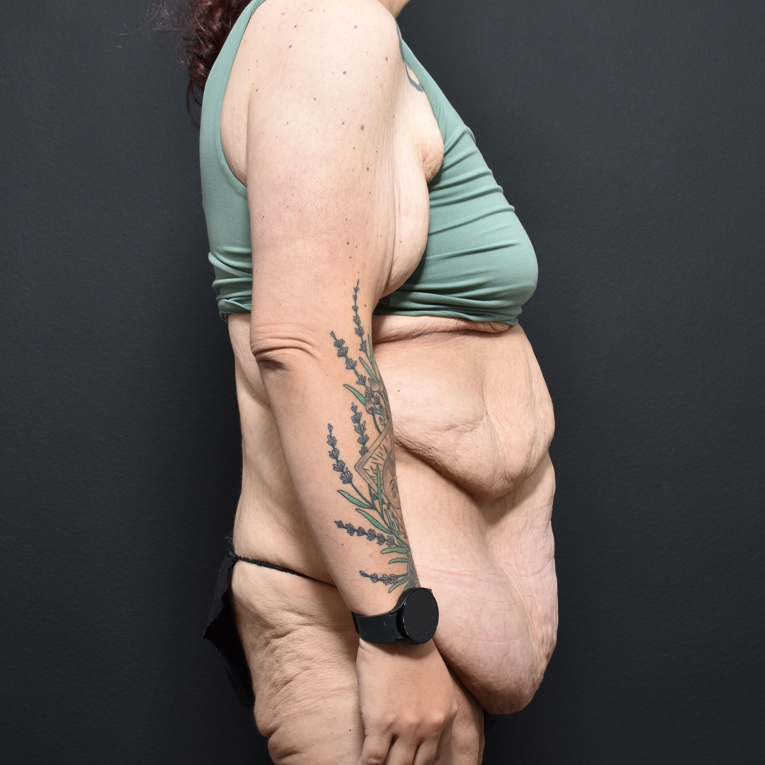 Case--8152 | Before Tummy Tuck 3