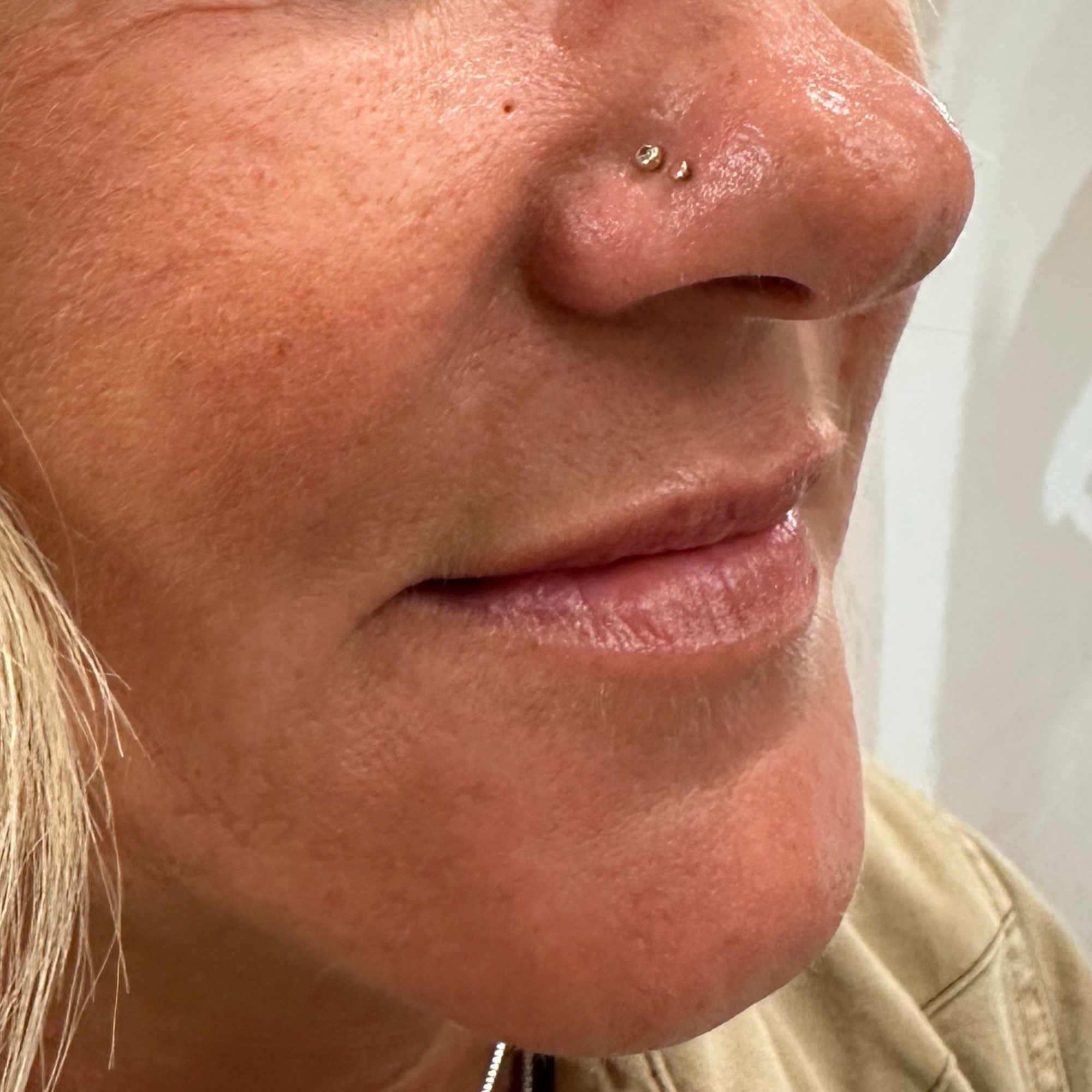 Case--8711 | Before Face Treatments