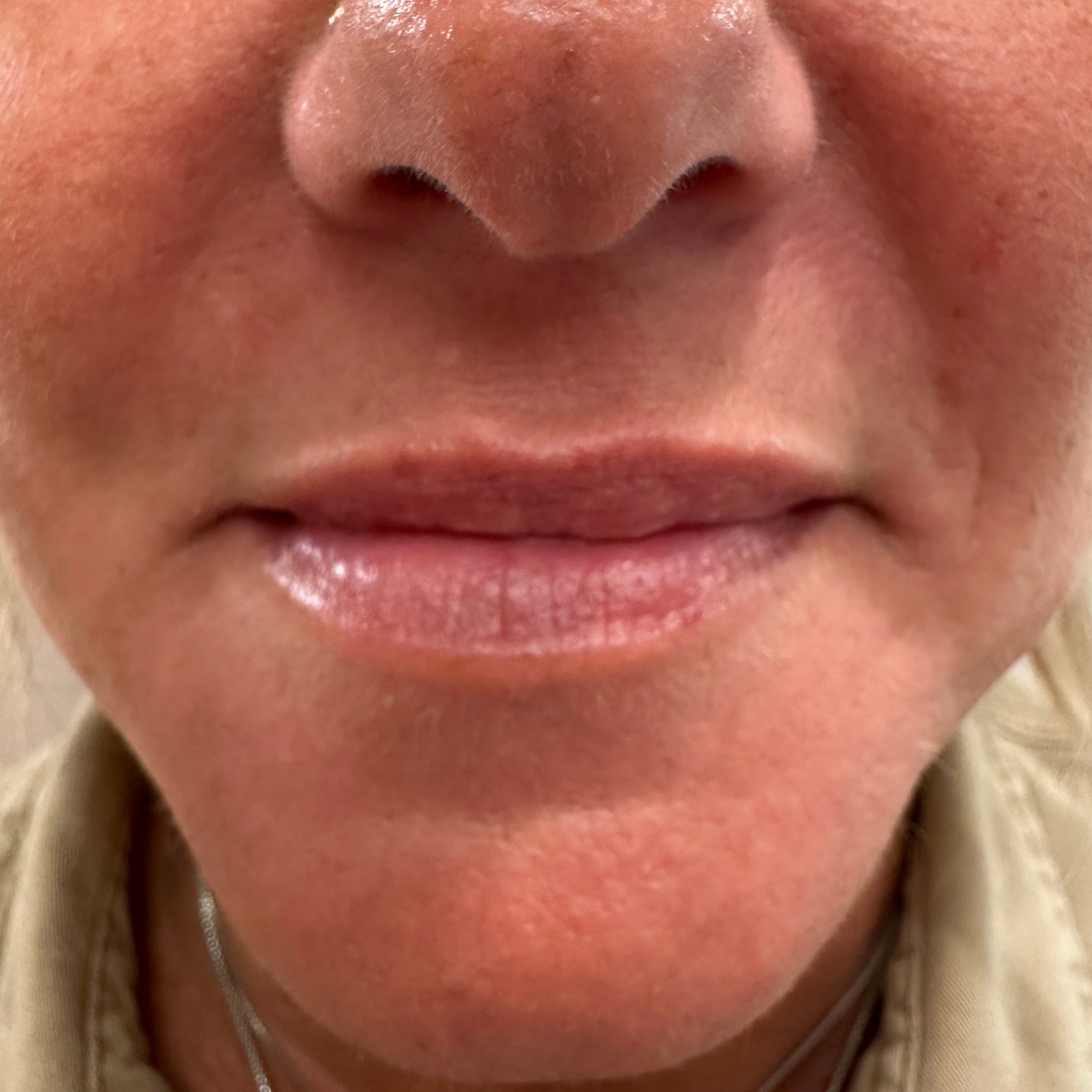 Case--8711 | Before Facial Fillers 2
