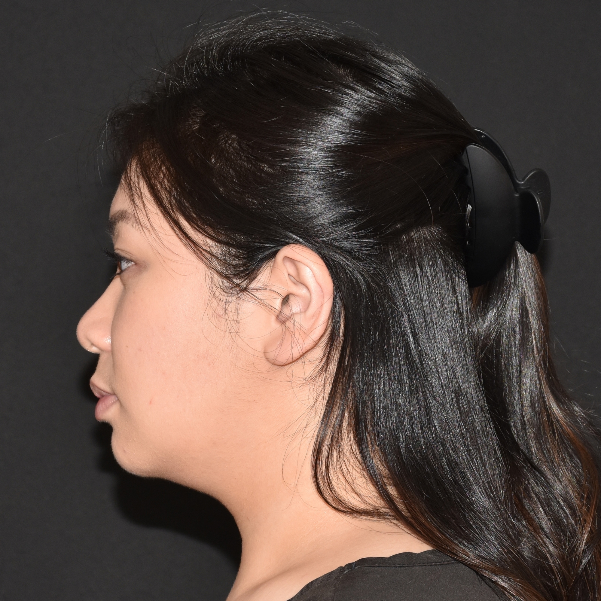 Case--4528 | Before Ultherapy and Sofwave 2