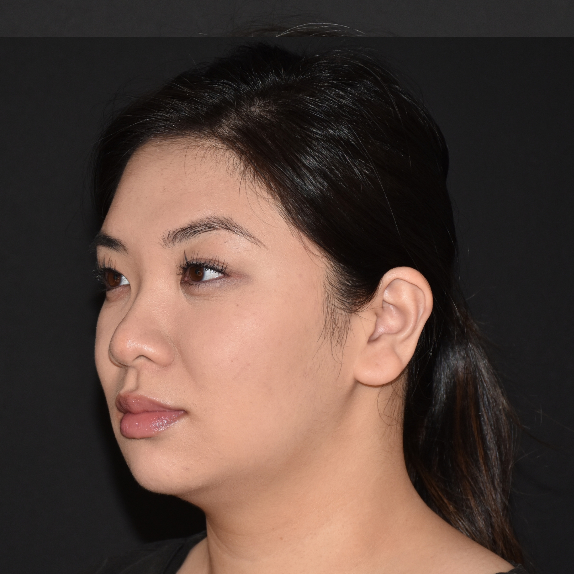 Case--4528 | After Ultherapy and Sofwave 3