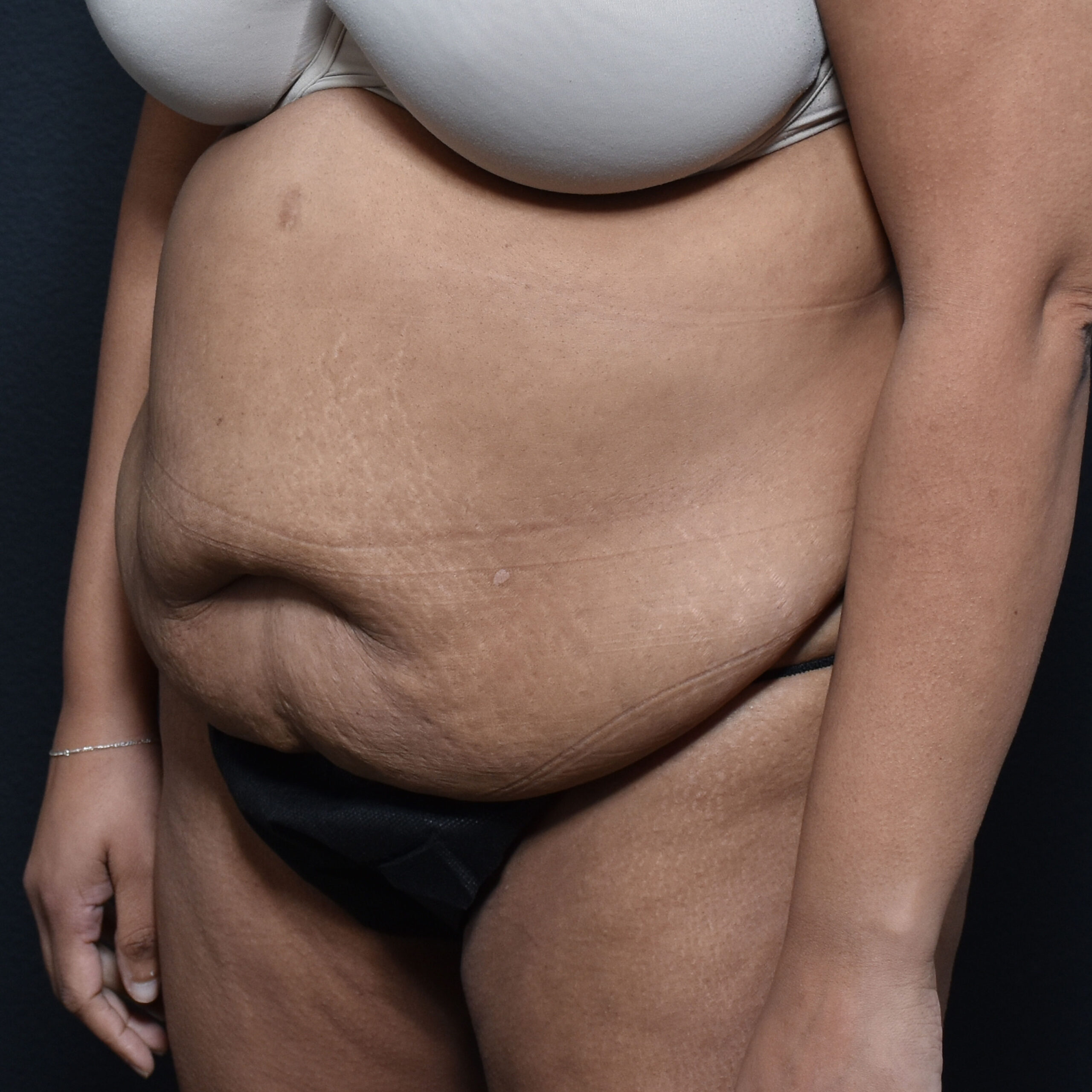 Case--8957 | Before Tummy Tuck 4