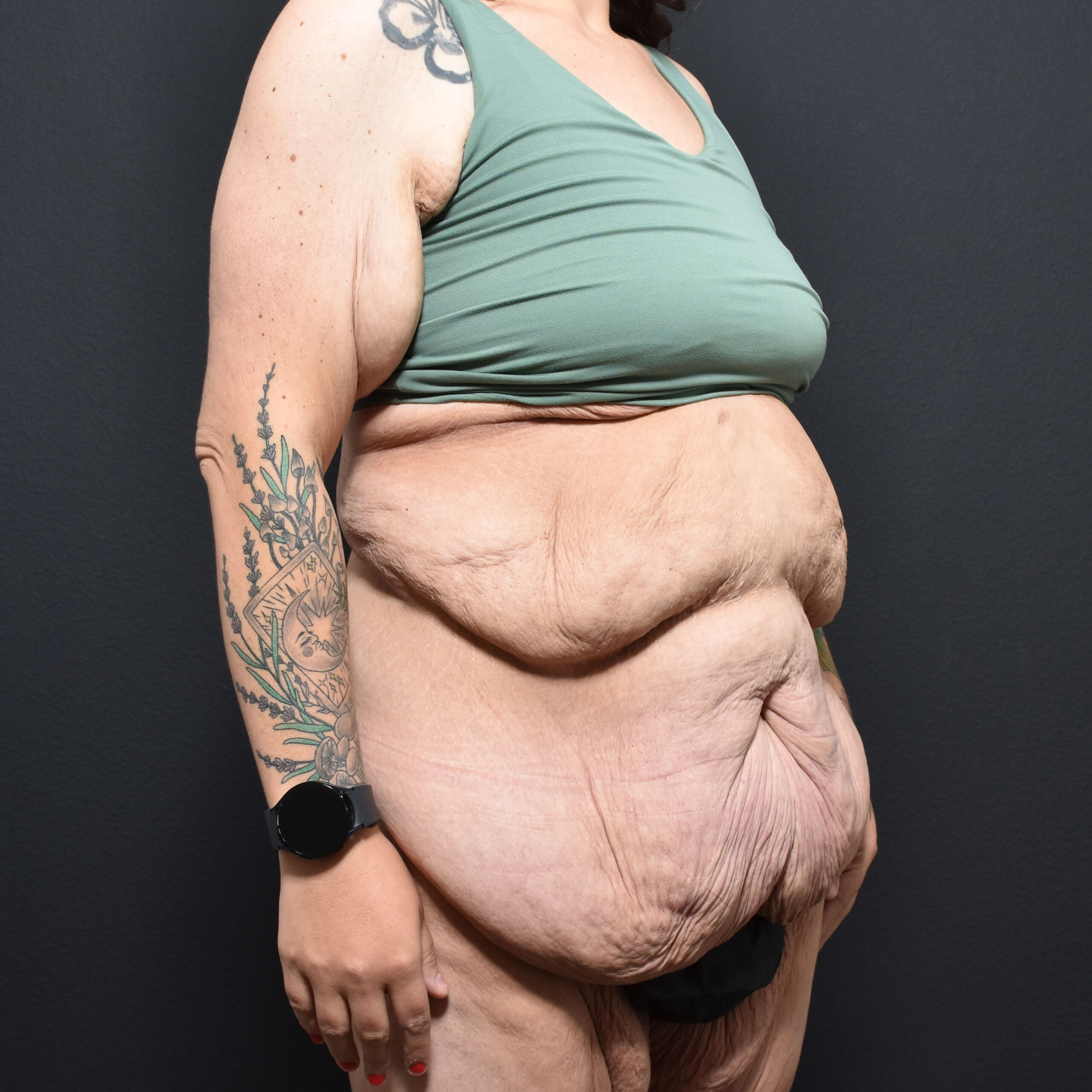 Case--2215 | Before Massive Weight Loss 2