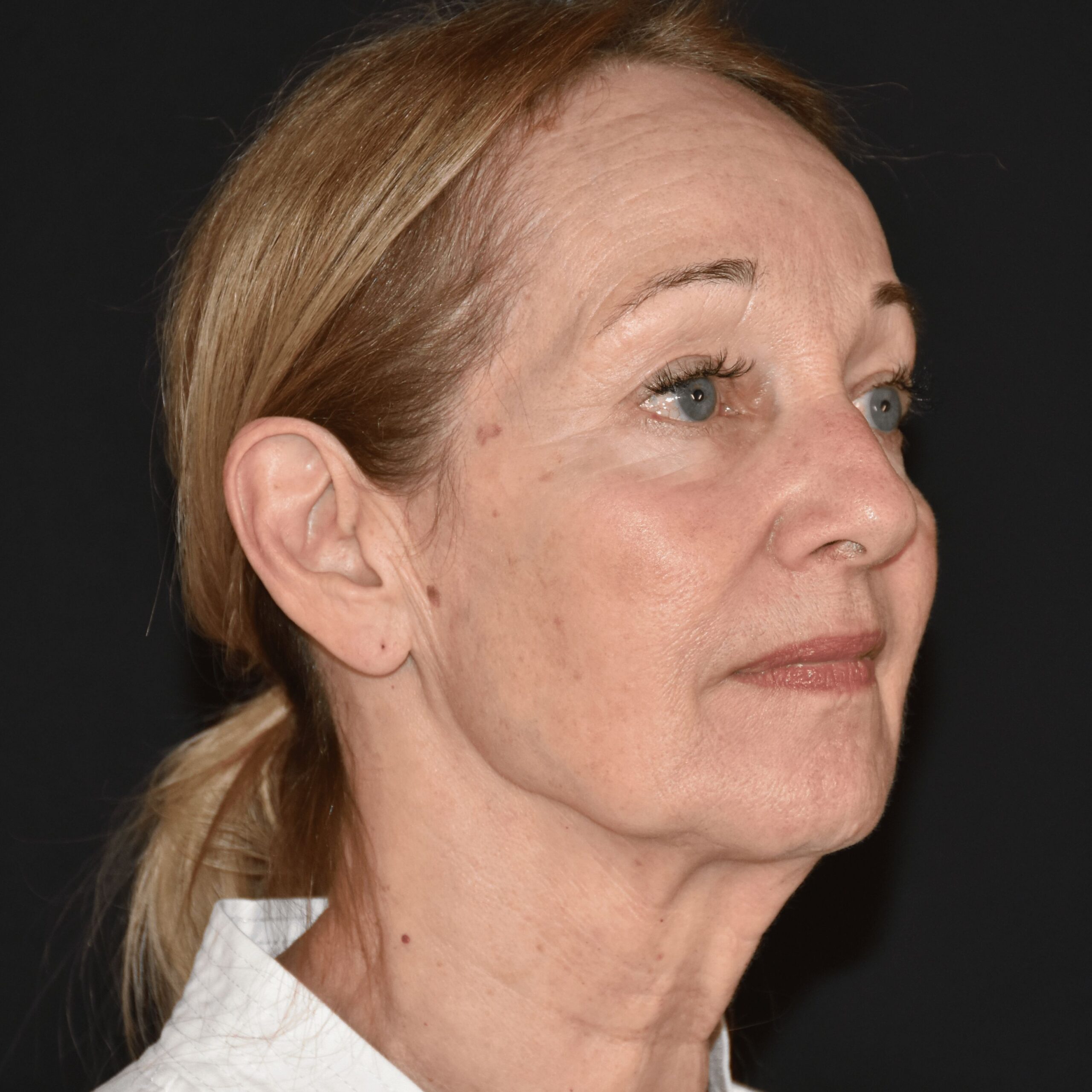 Case--3707 | Before Upper Blepharoplasty 2