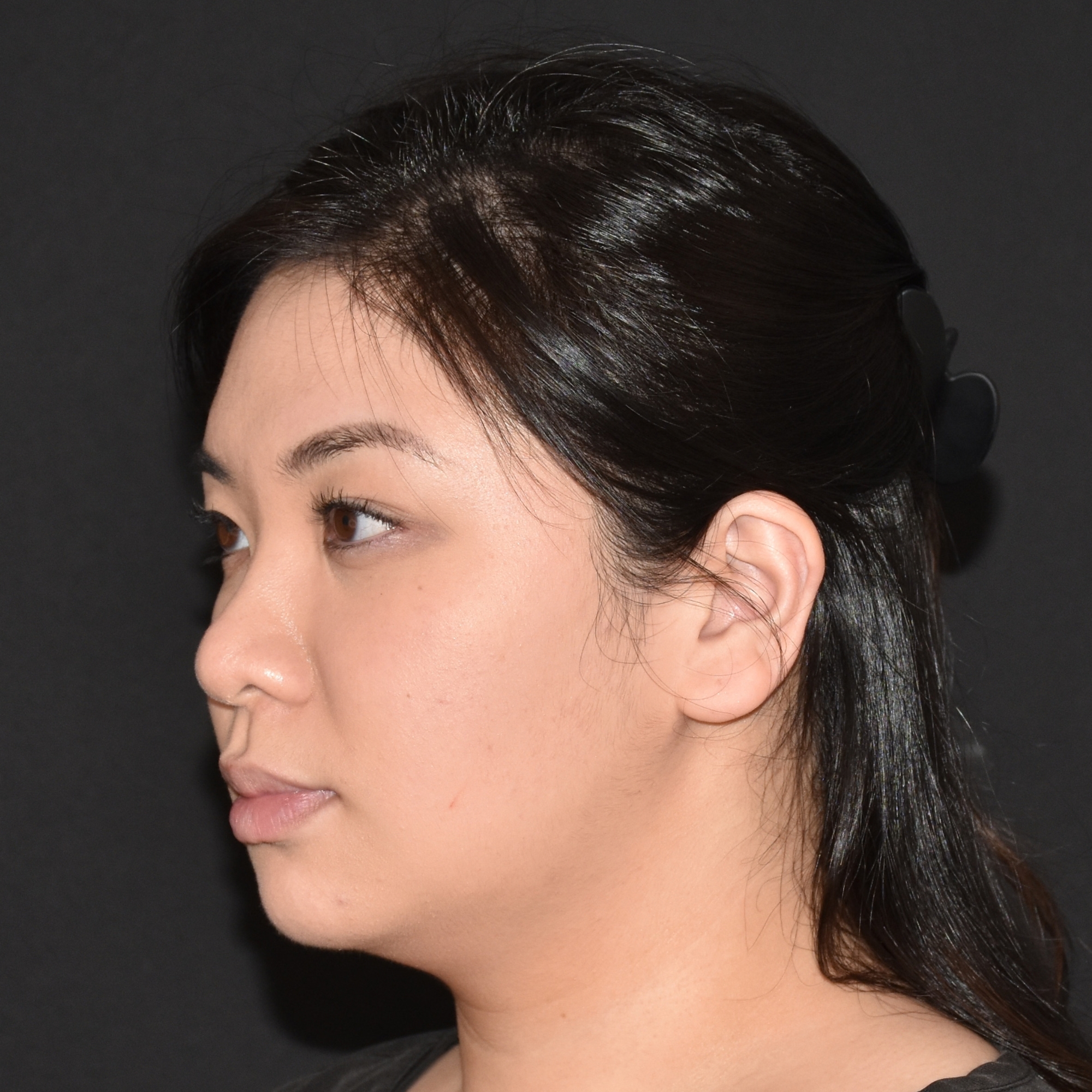 Case--4528 | Before Ultherapy and Sofwave 3