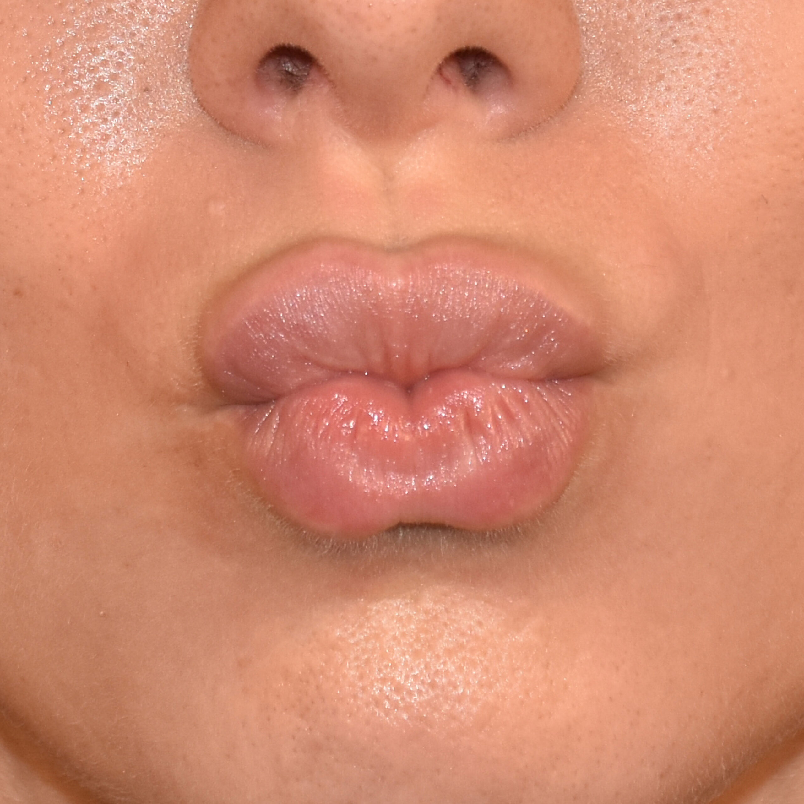 Case--5950 | After Facial Fillers