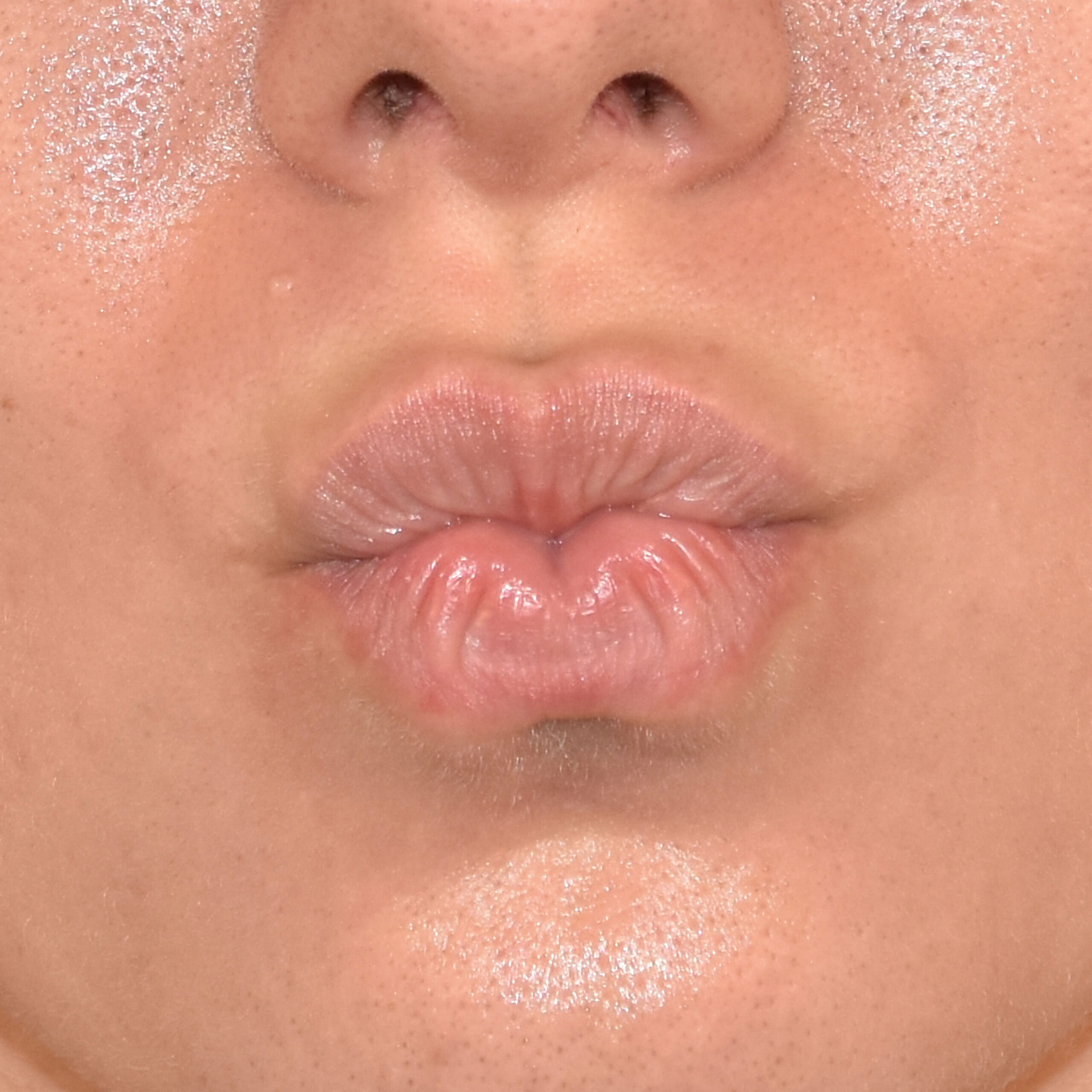 Case--5950 | Before Facial Fillers