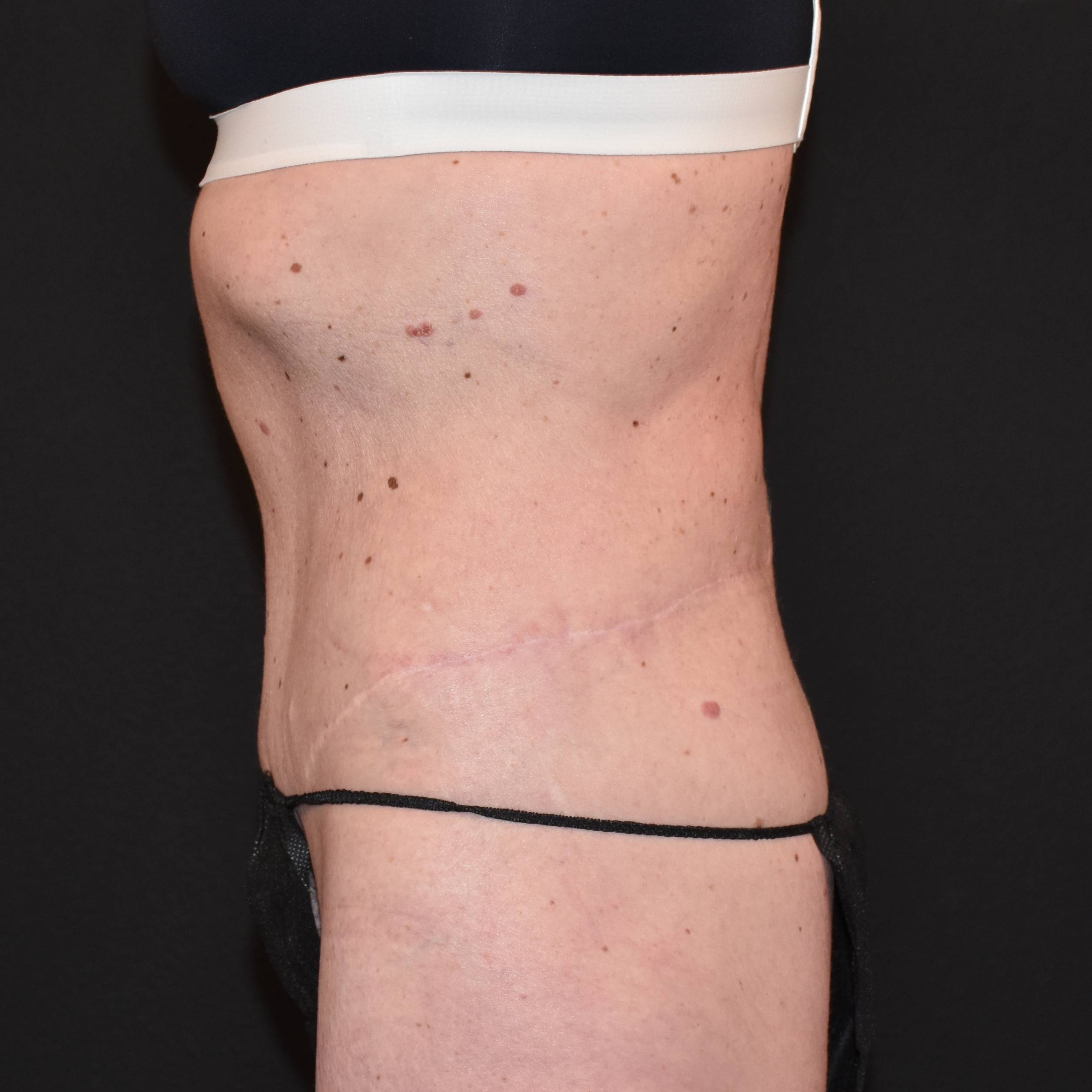 Case--5573 | After Backplasty 2