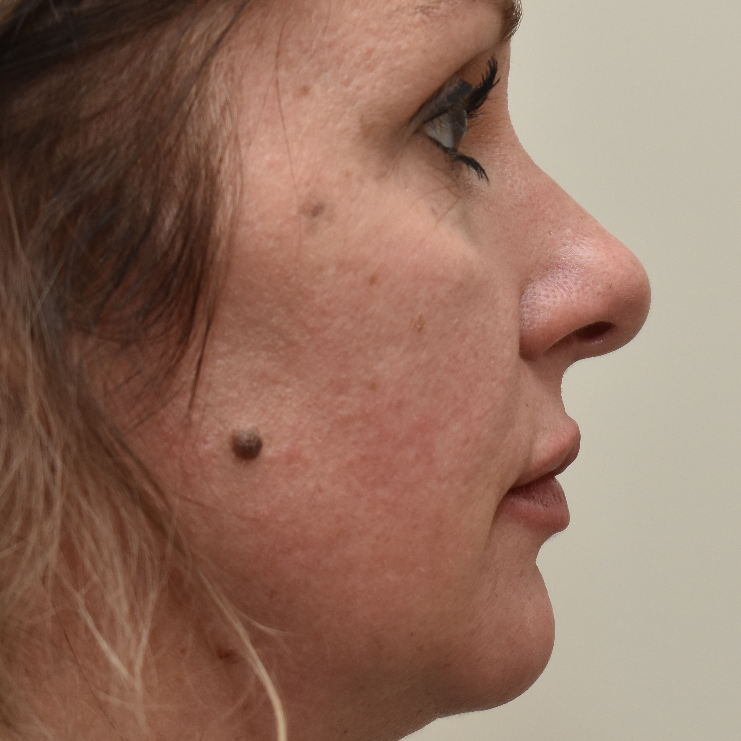 Case--4475 | After Facial Fillers 3