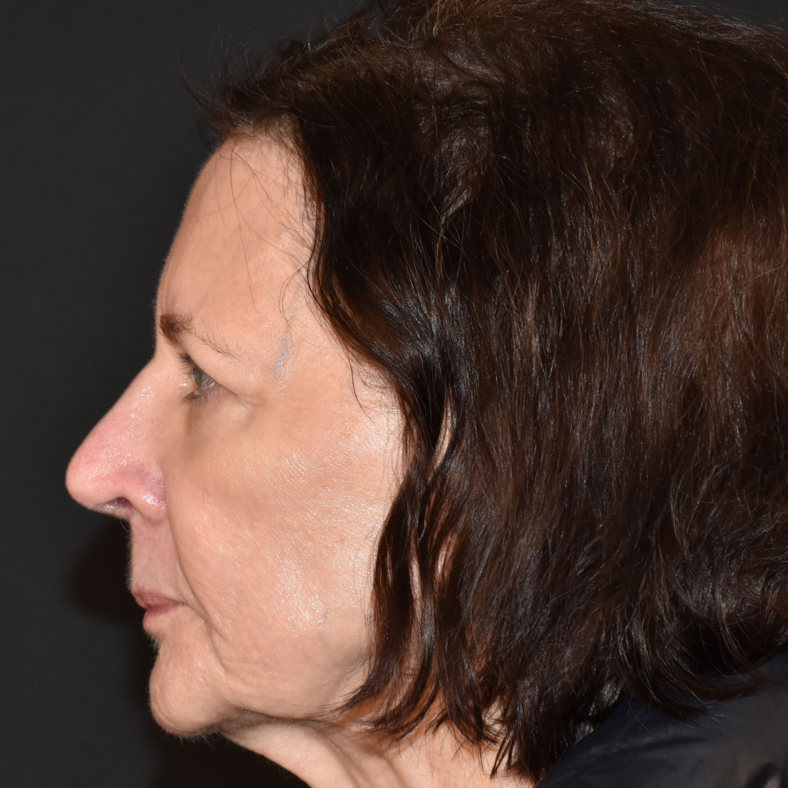 Case--1382 | After Facial Fillers 3