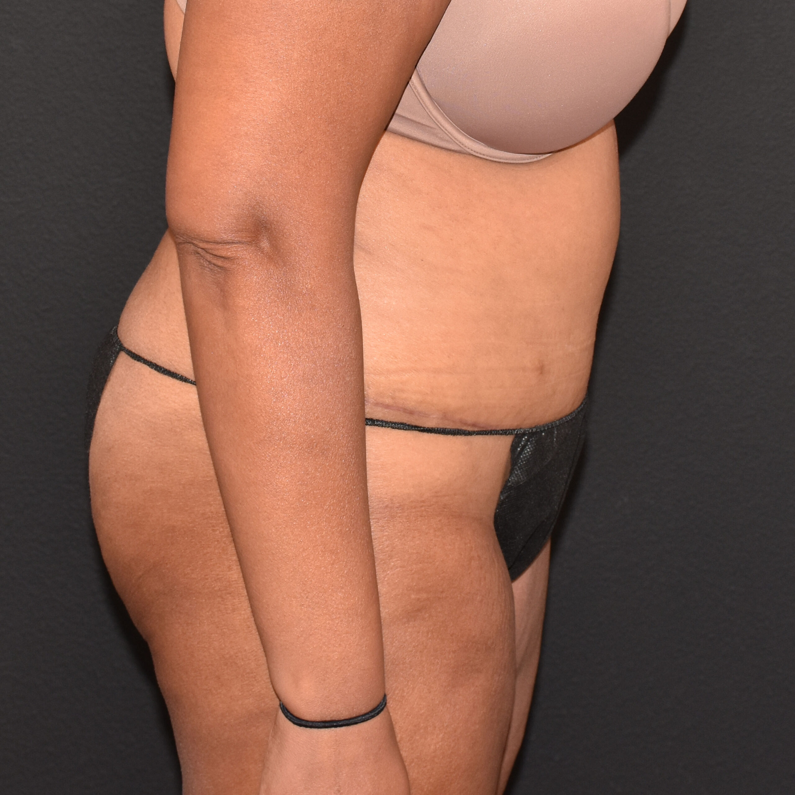 Case--8957 | After Tummy Tuck 3