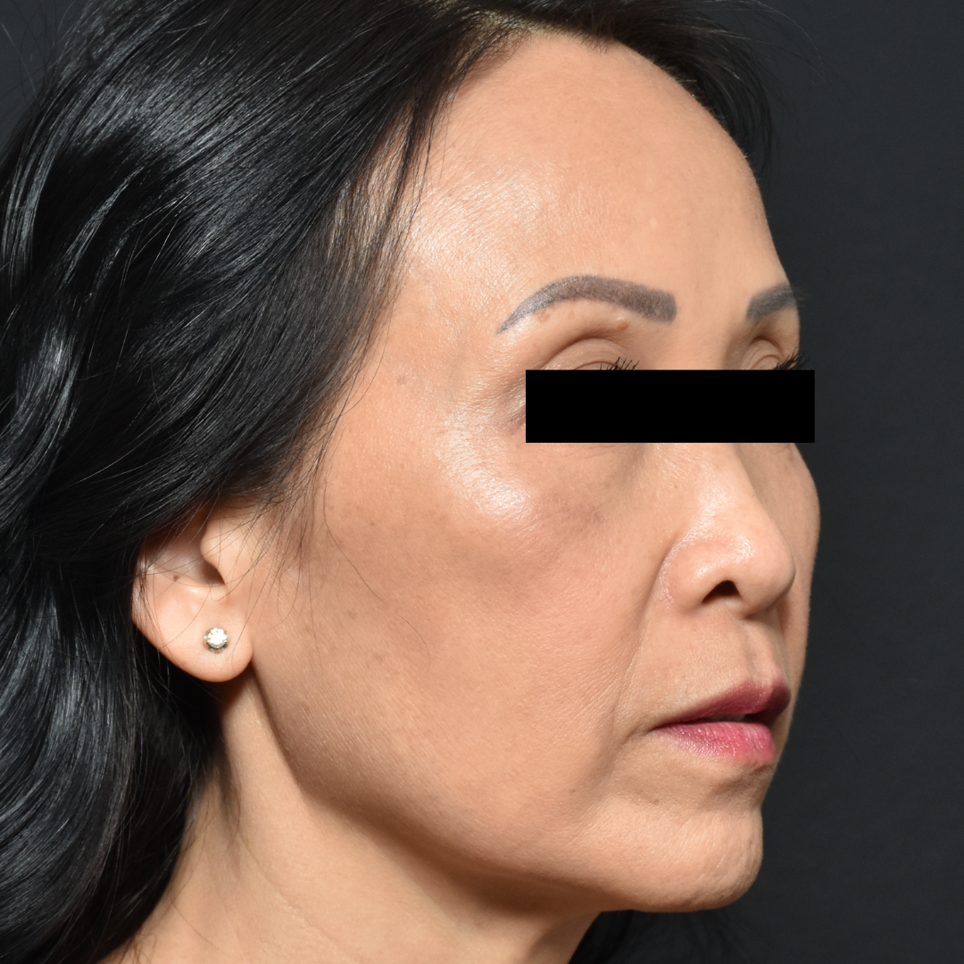 Case--7237 | After Facials and Peels 2