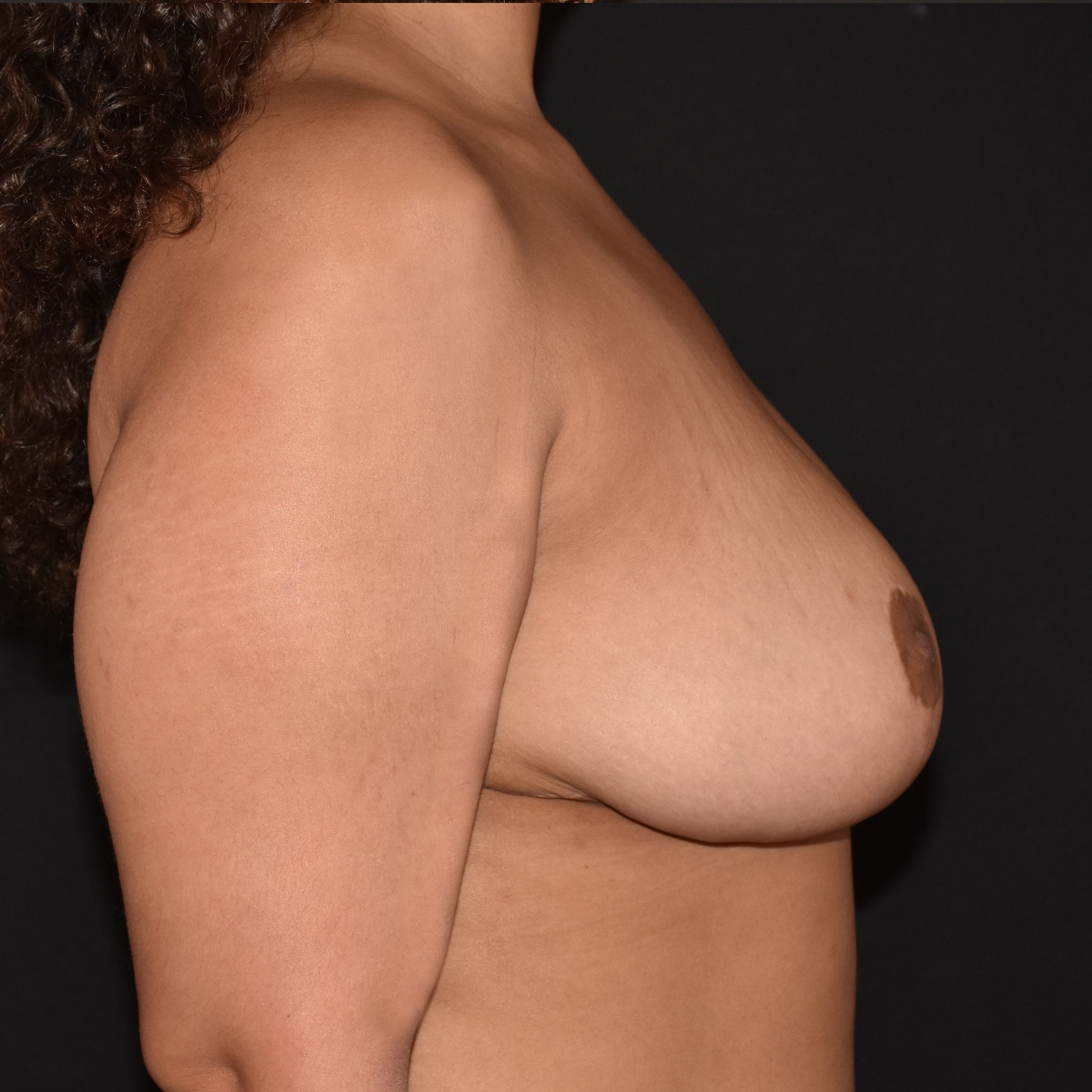 Case--1098 | After Breast Reduction 5