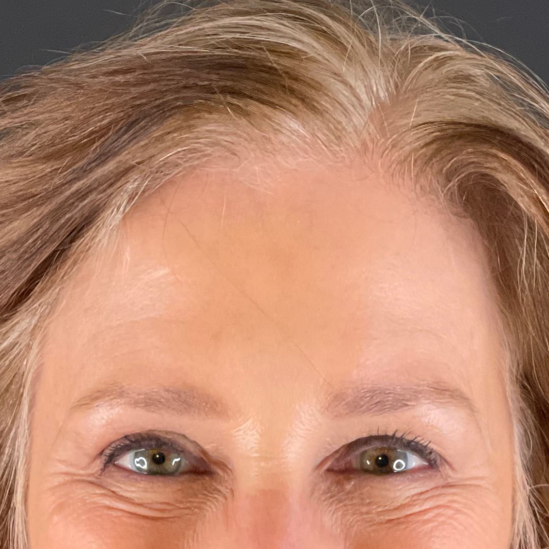 Case--3186 | After Face Treatments