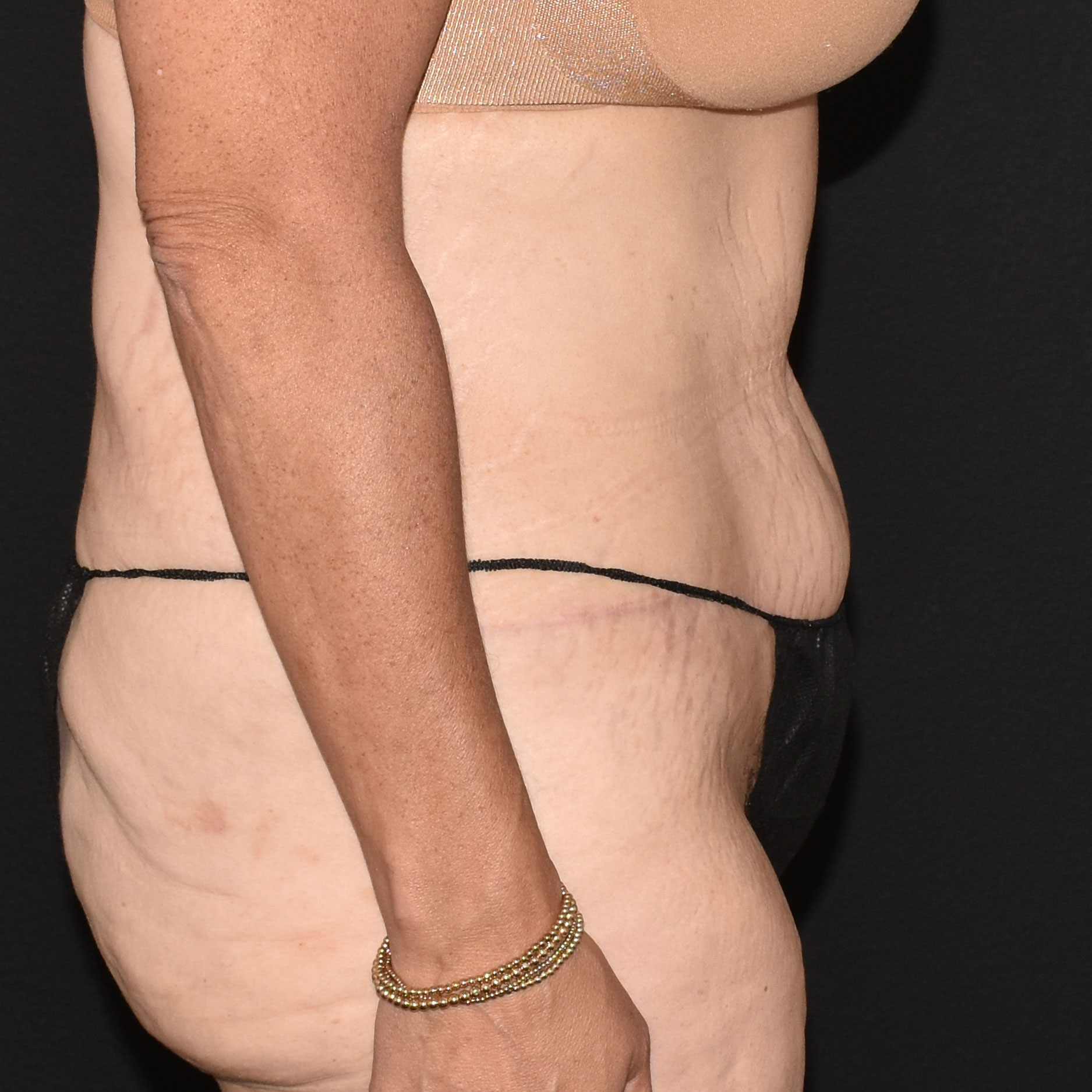 Case--2416 | After Tummy Tuck 5