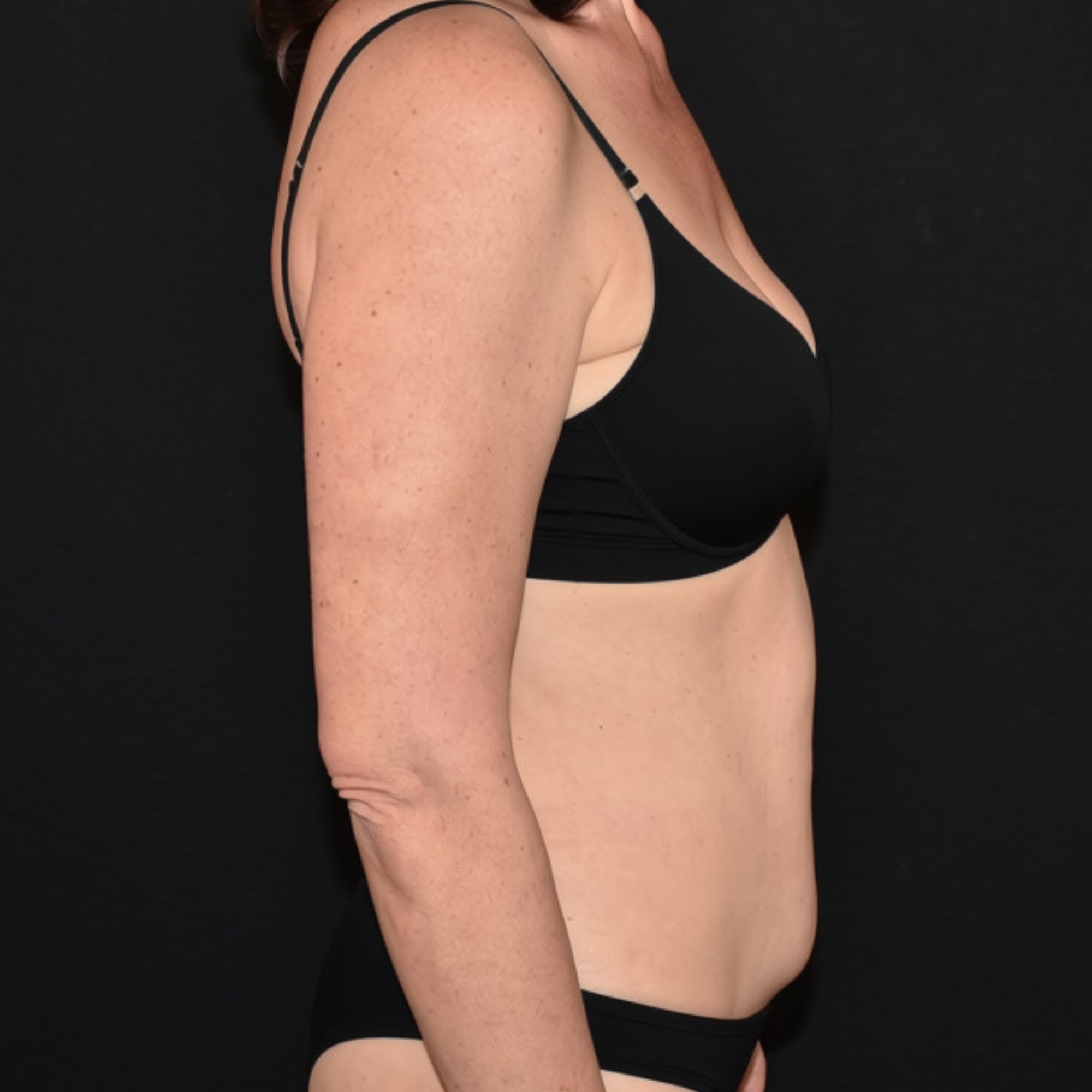 Case--3430 | Before Tummy Tuck 5