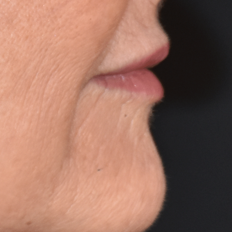 Case--4199 | After Facial Fillers 2