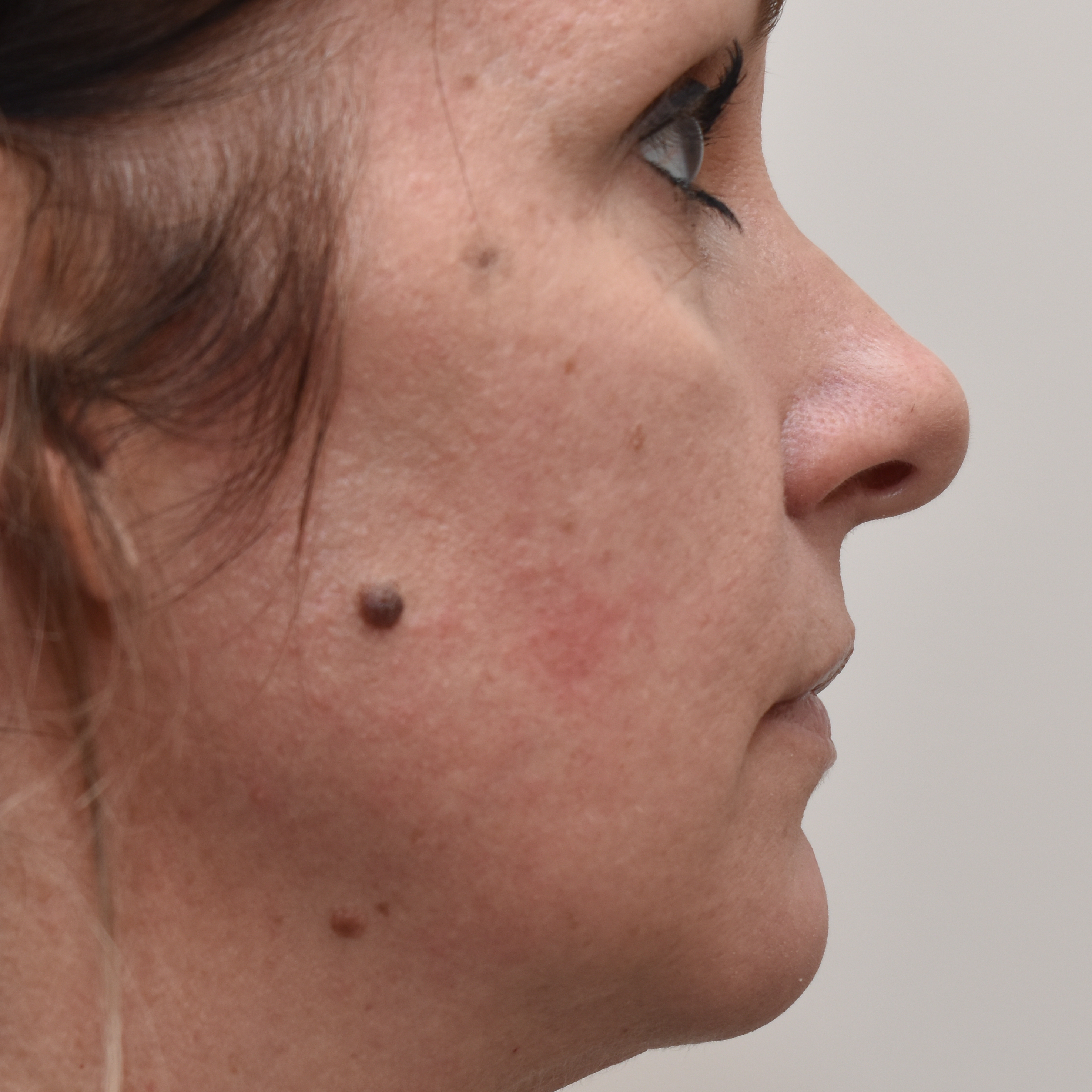 Case--4475 | Before Facial Fillers 3