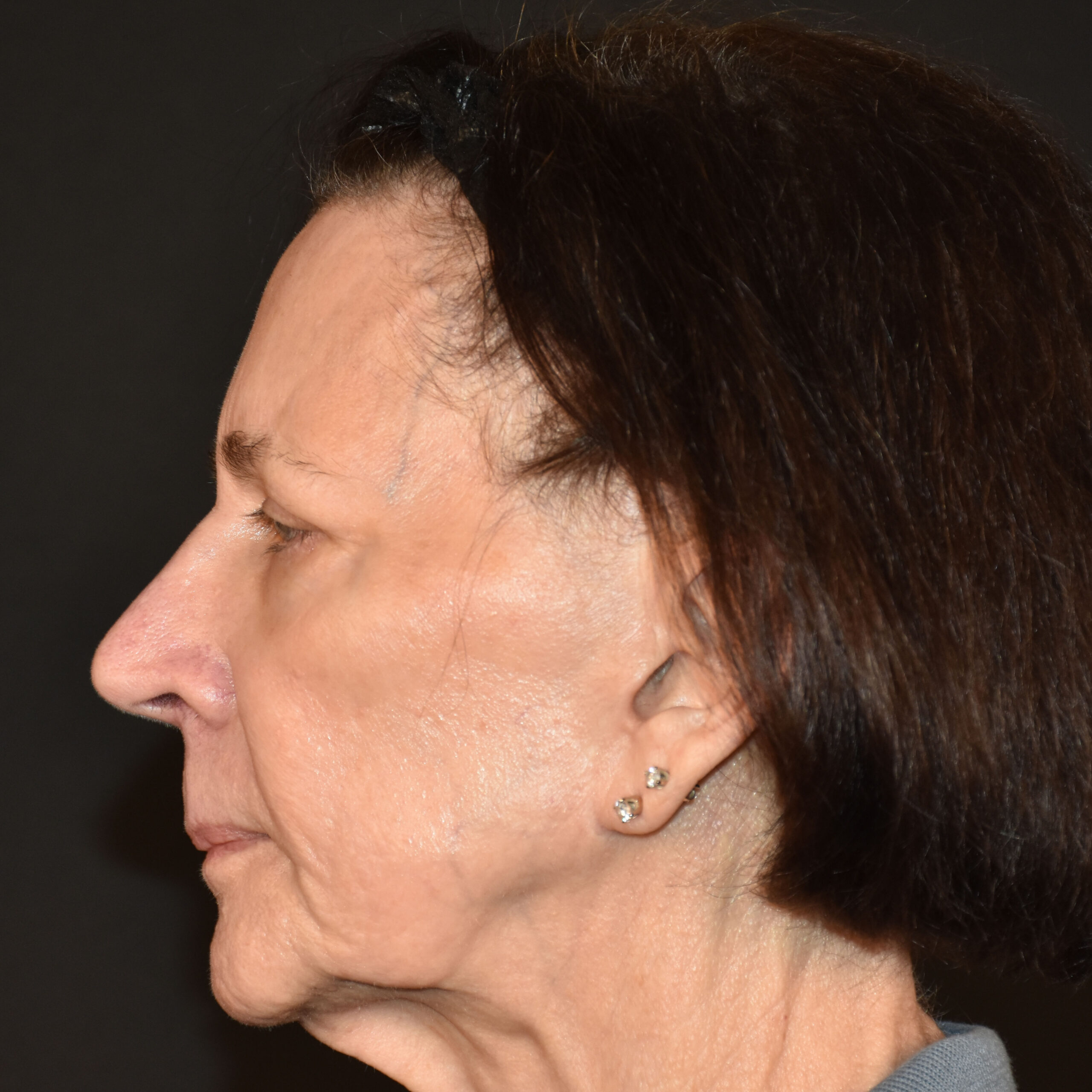 Case--1382 | Before Facial Fillers 3