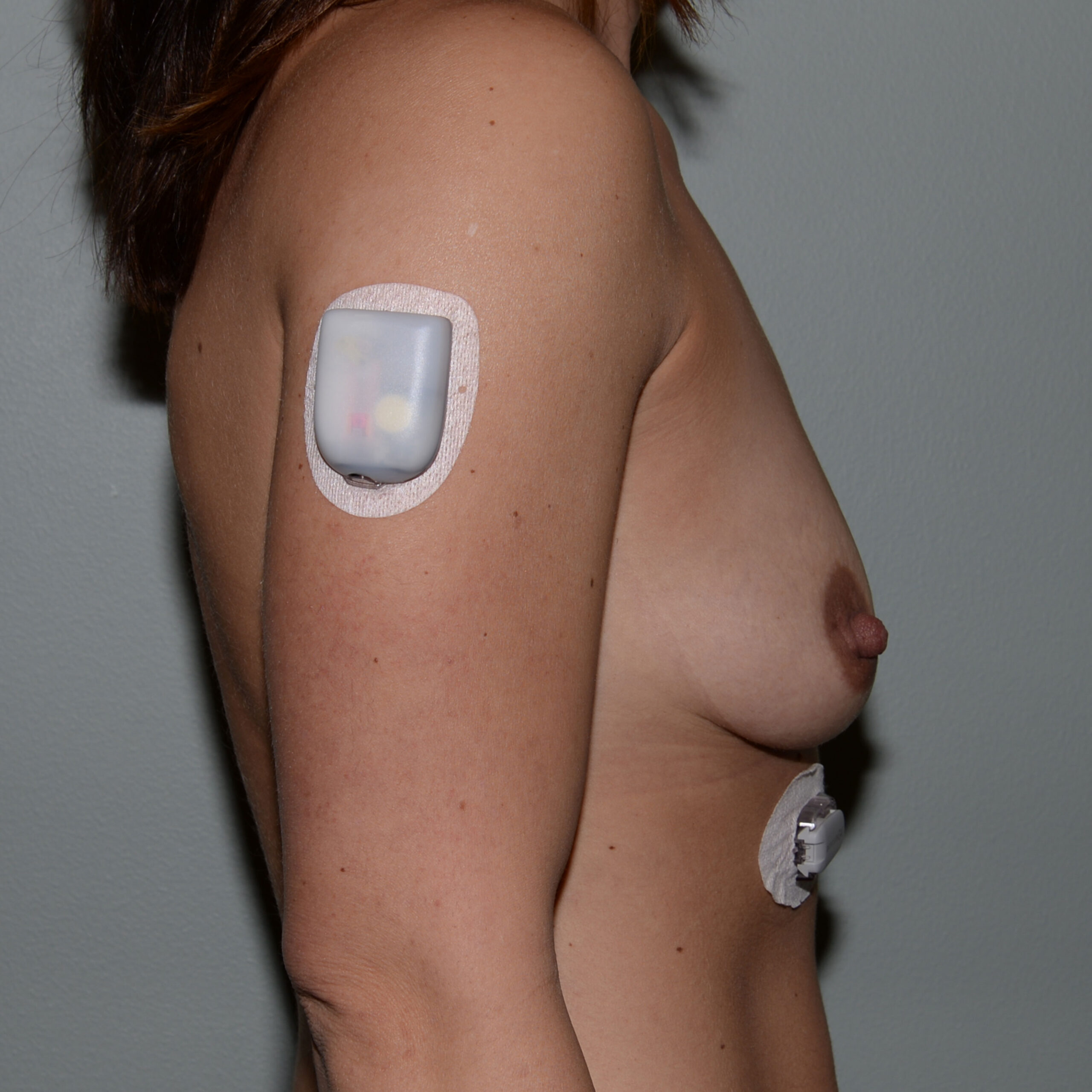 Case--2940 | Before Breast Augmentation 3