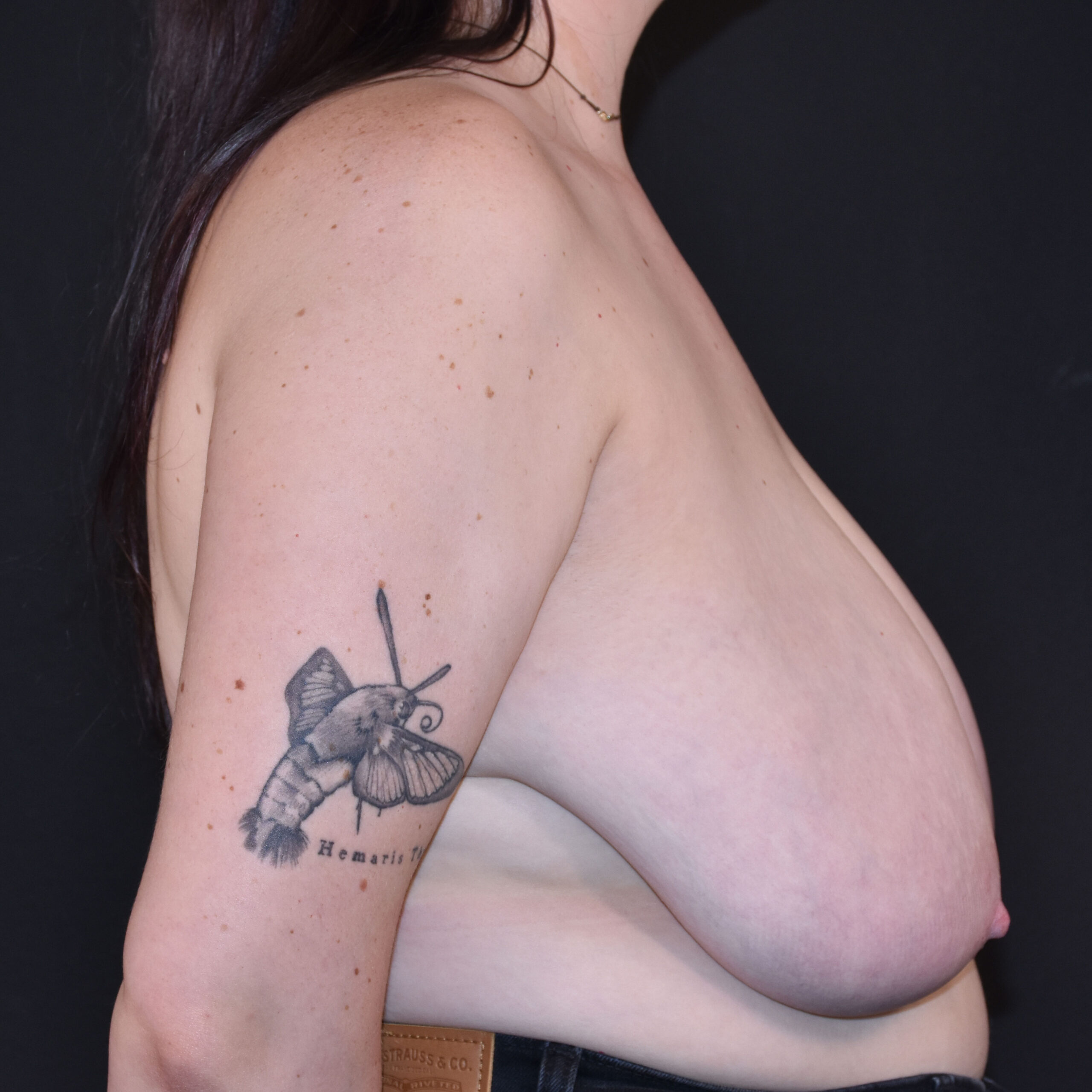 Case--6263 | Before Breast Reduction 5