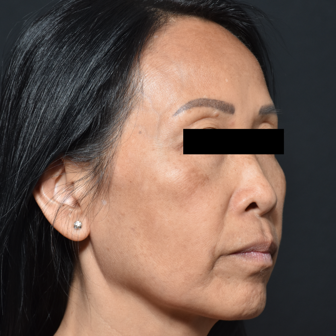 Case--7237 | Before Facials and Peels 2