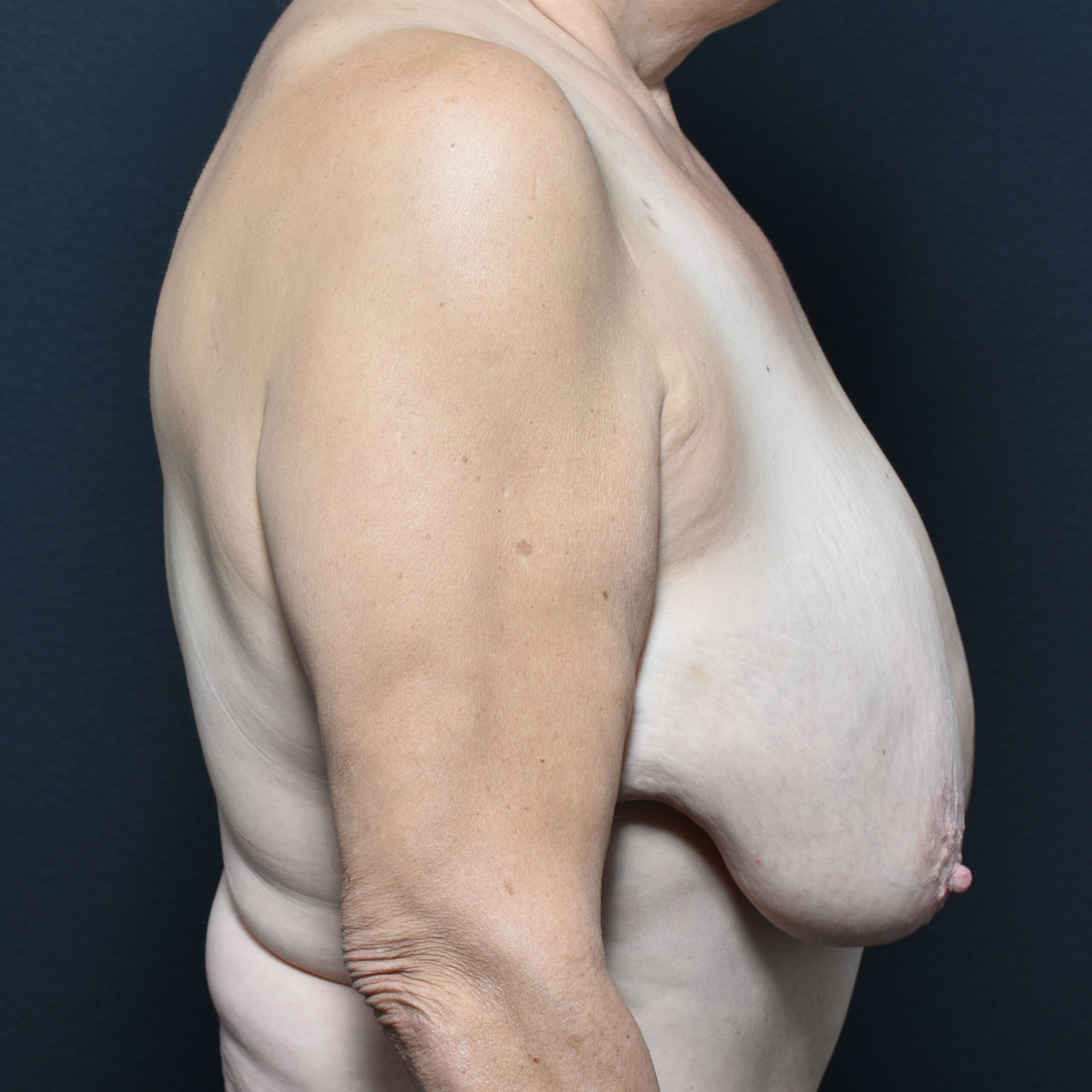 Case--7925 | Before Breast Reduction 3