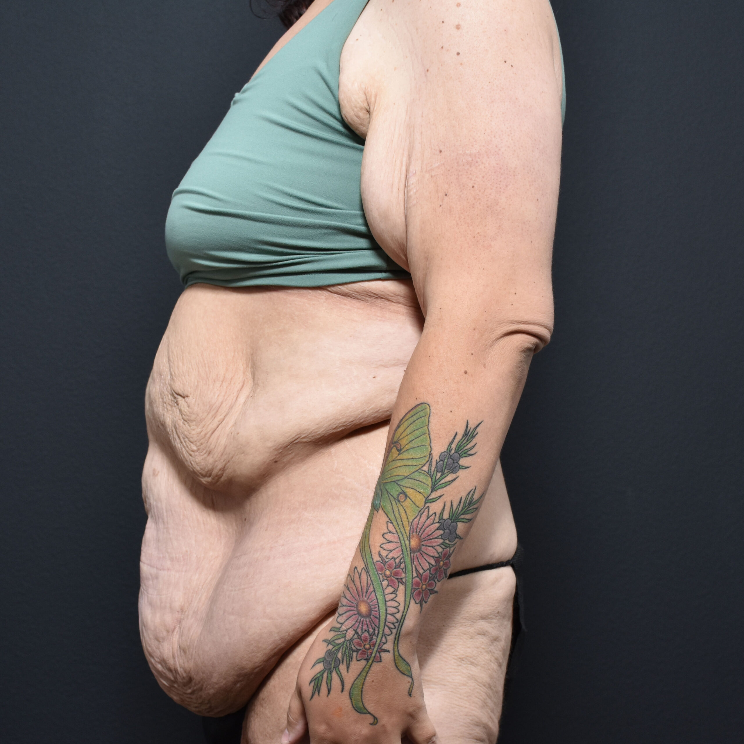 Case--2215 | Before Massive Weight Loss 5