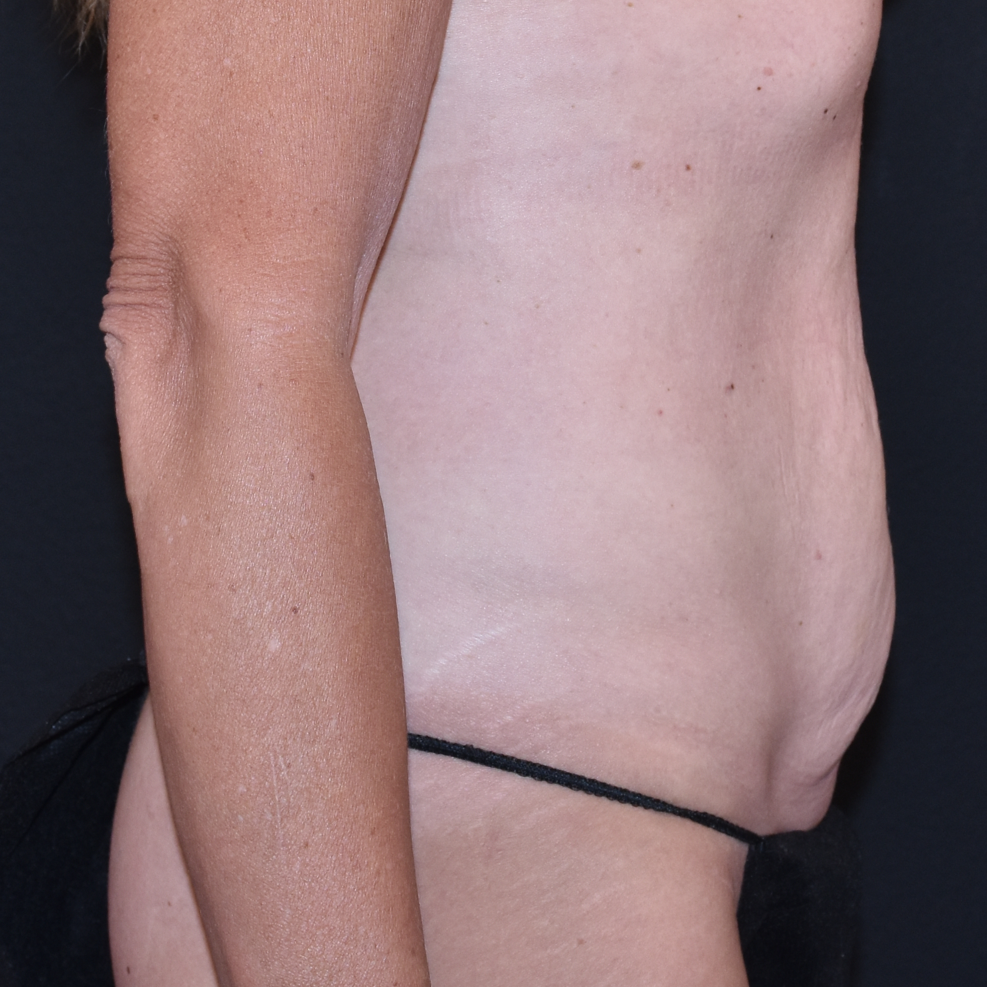 Case--4933 | Before Tummy Tuck 5