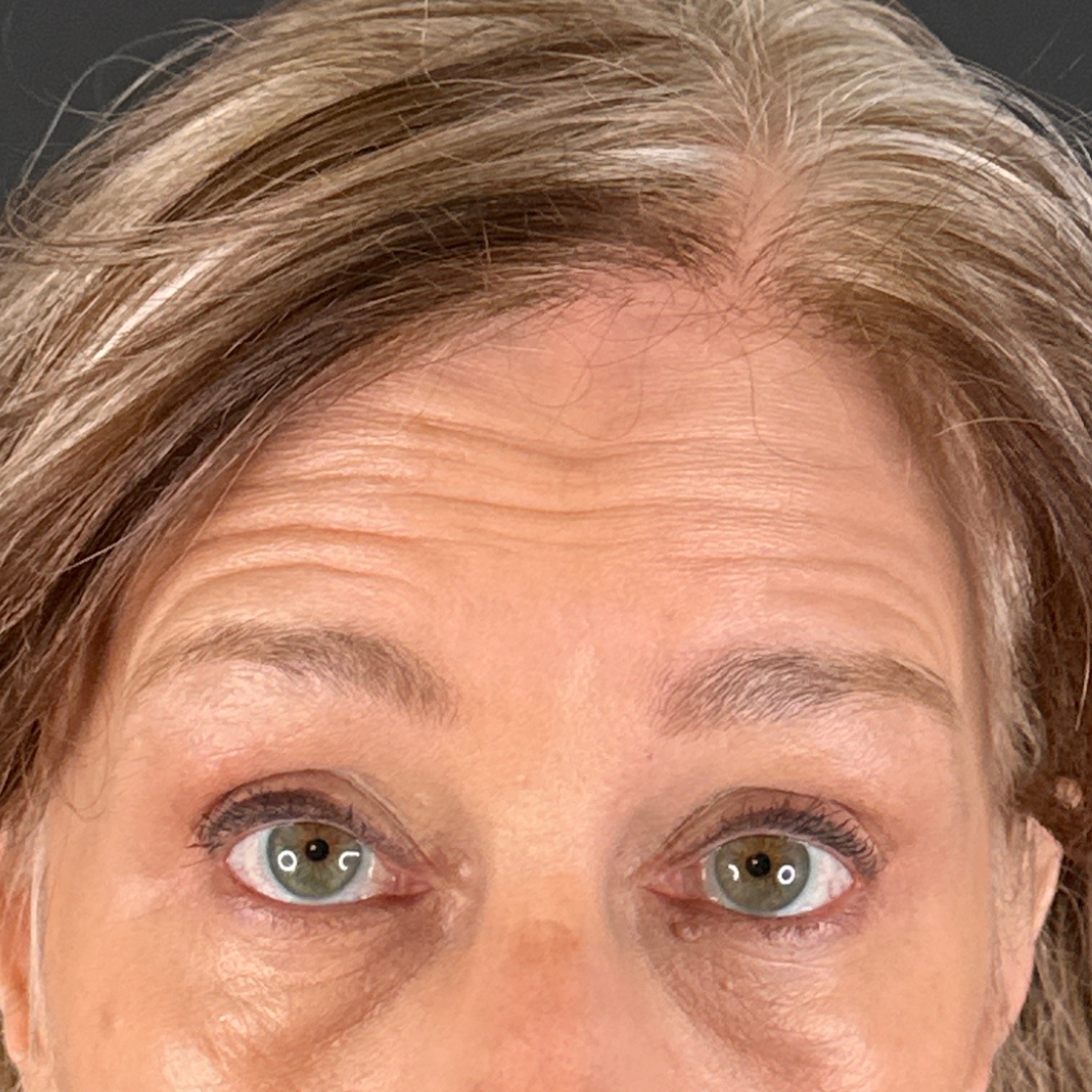 Case--3186 | Before Face Treatments