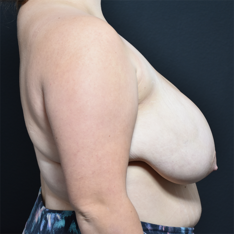 Case--9717 | Before Breast Reduction 5