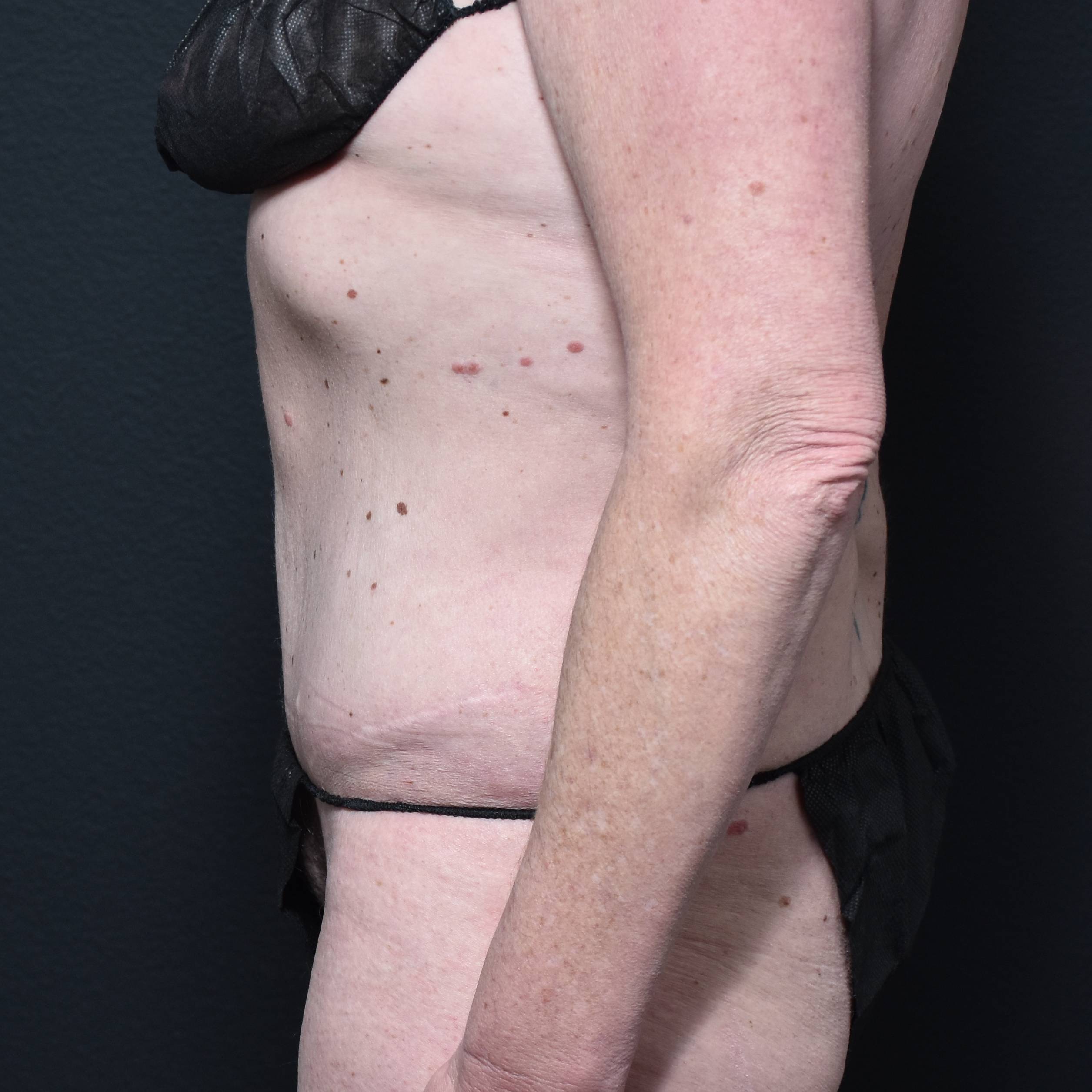 Case--5573 | Before Backplasty 2