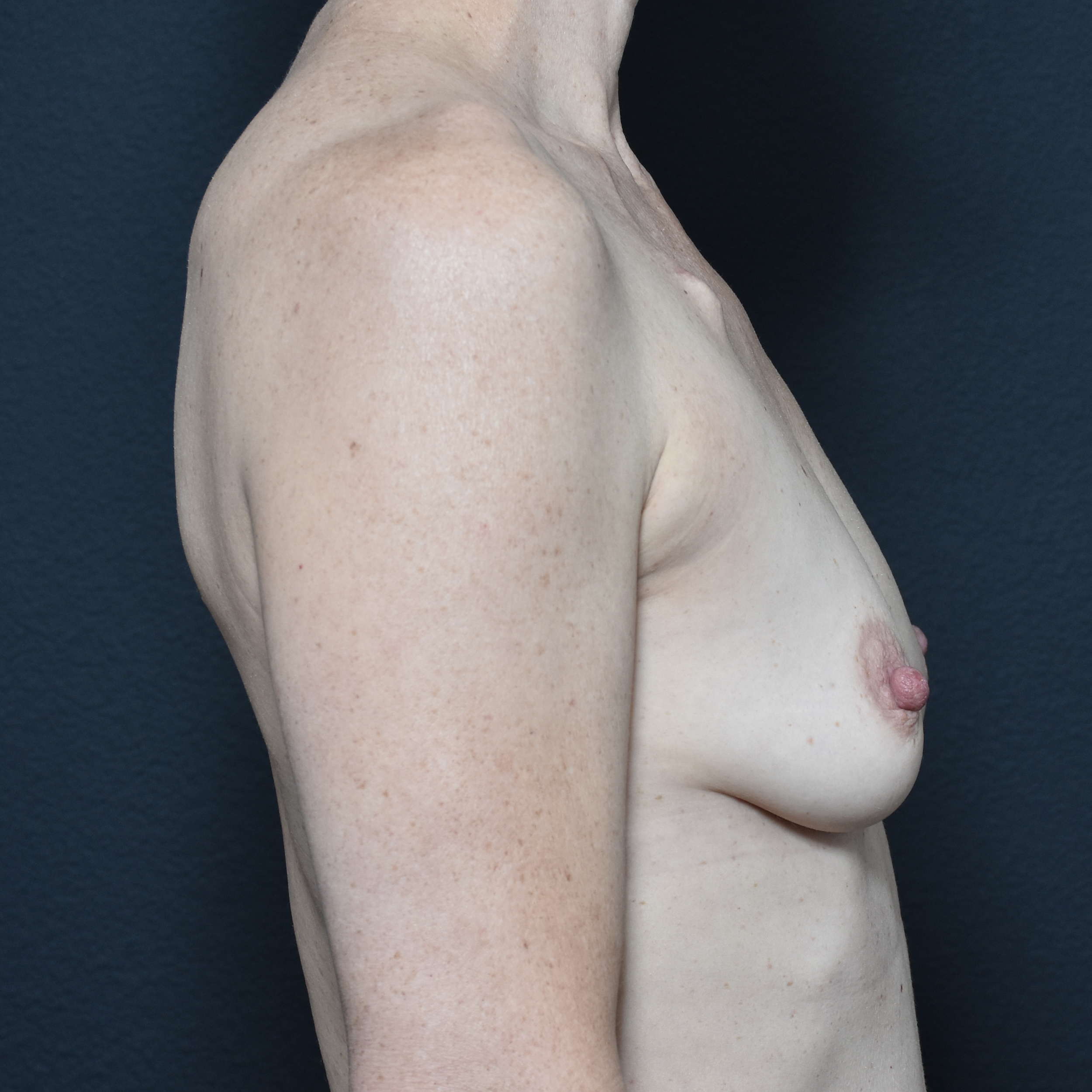 Case--4665 | Before Breast Reconstruction 5