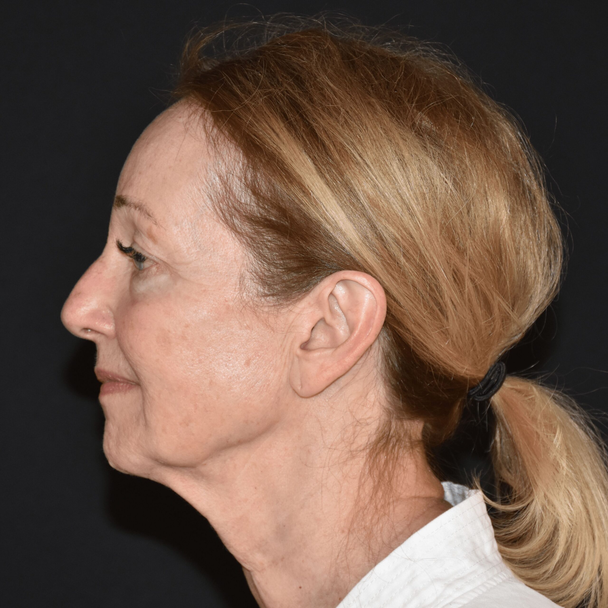 Case--3488 | Before Facelift and Neck Lift 5