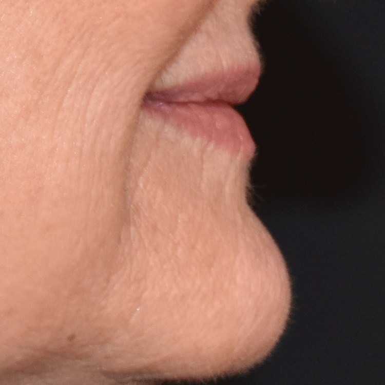 Case--4199 | Before Facial Fillers 2