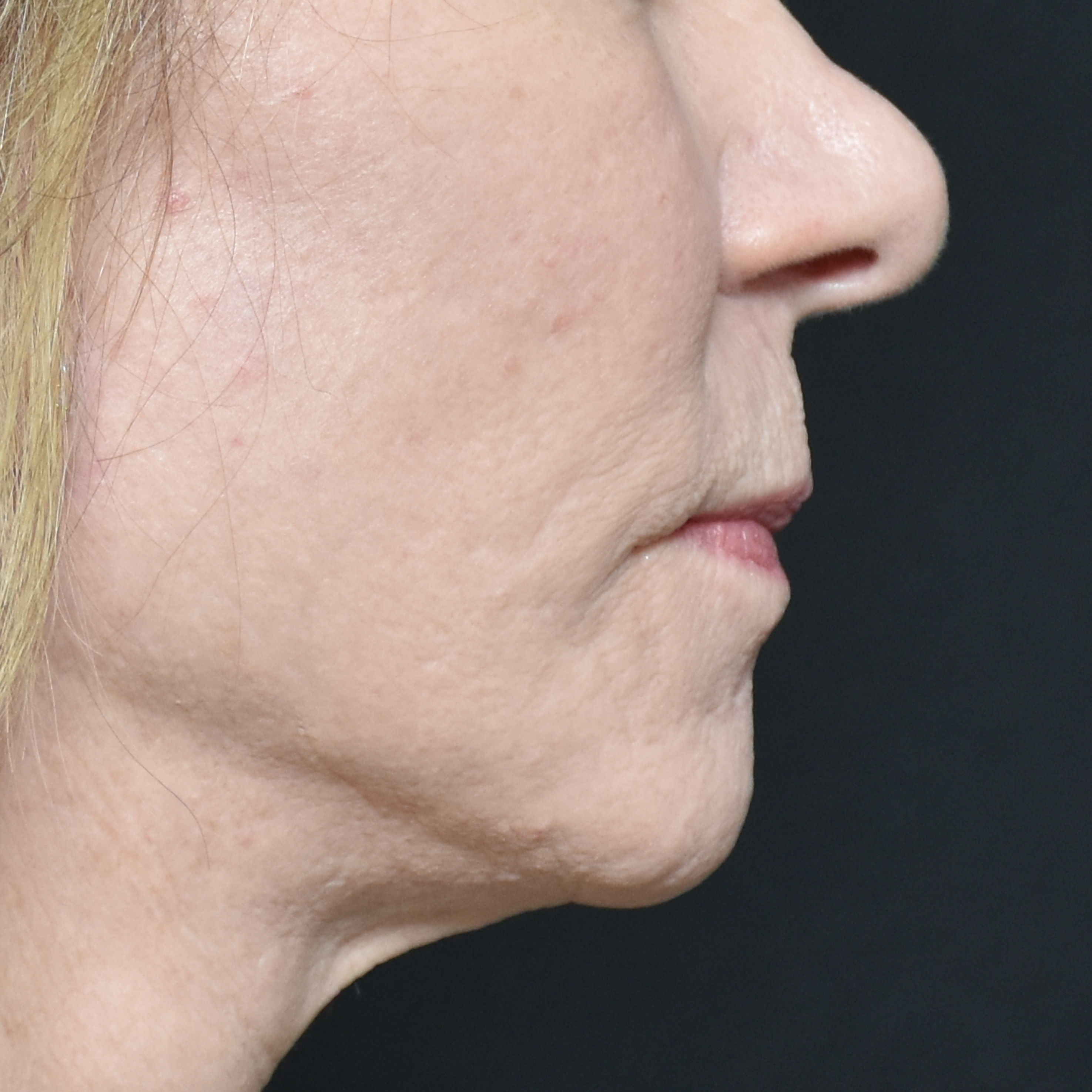 Case--5516 | Before Lip Lift 2