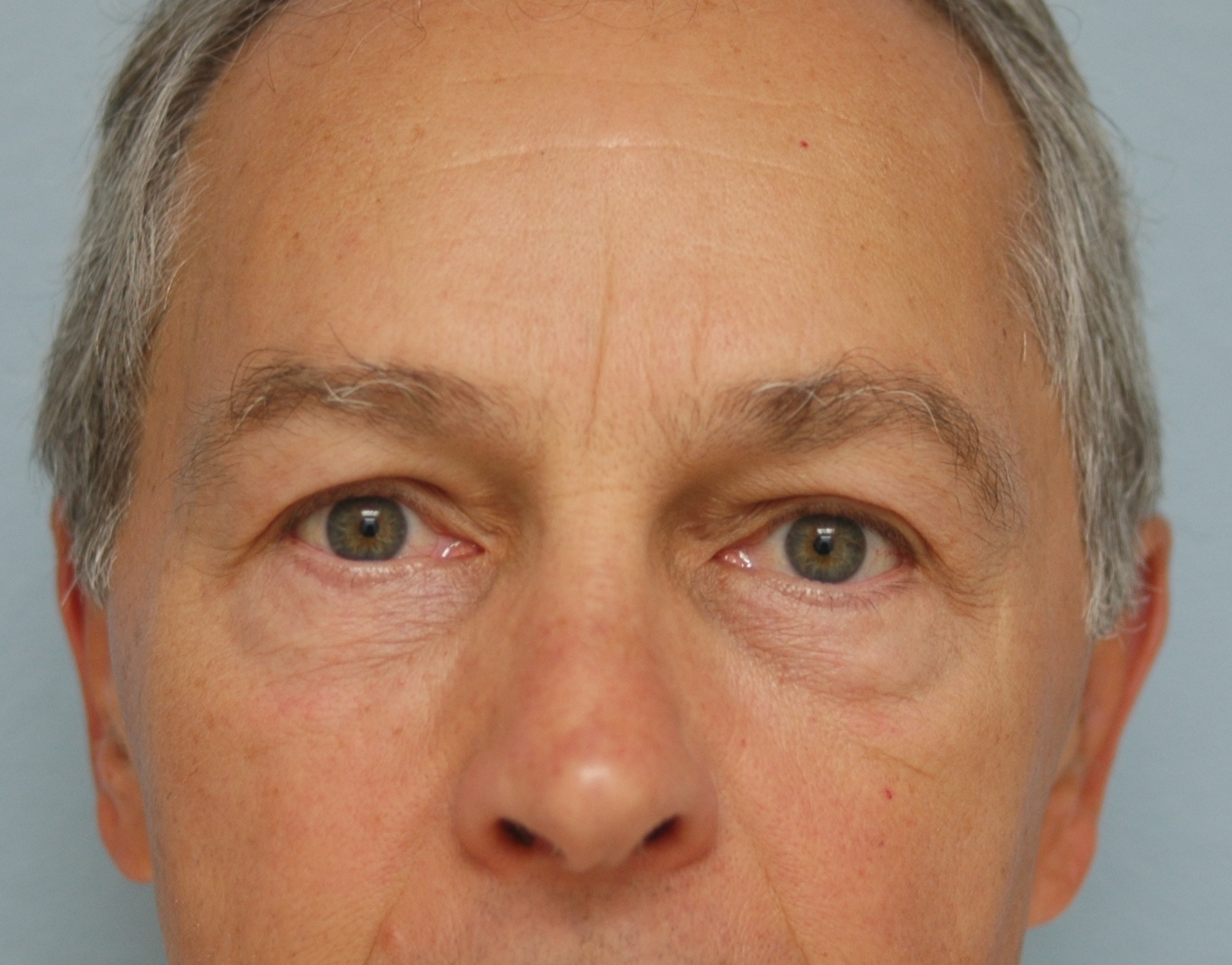 Case--4034 | After Face