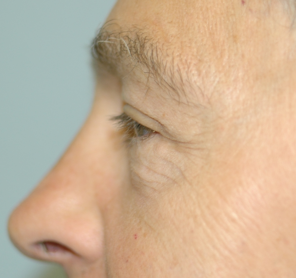Case--4034 | After Lower Blepharoplasty 2