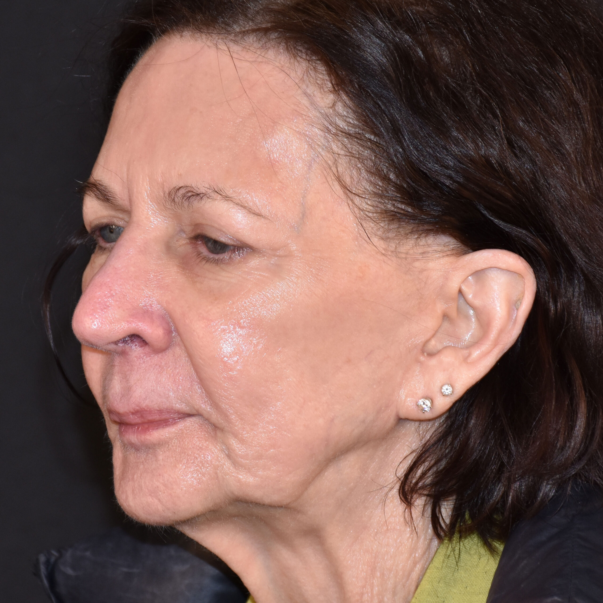 Case--1382 | After Facial Fillers 4