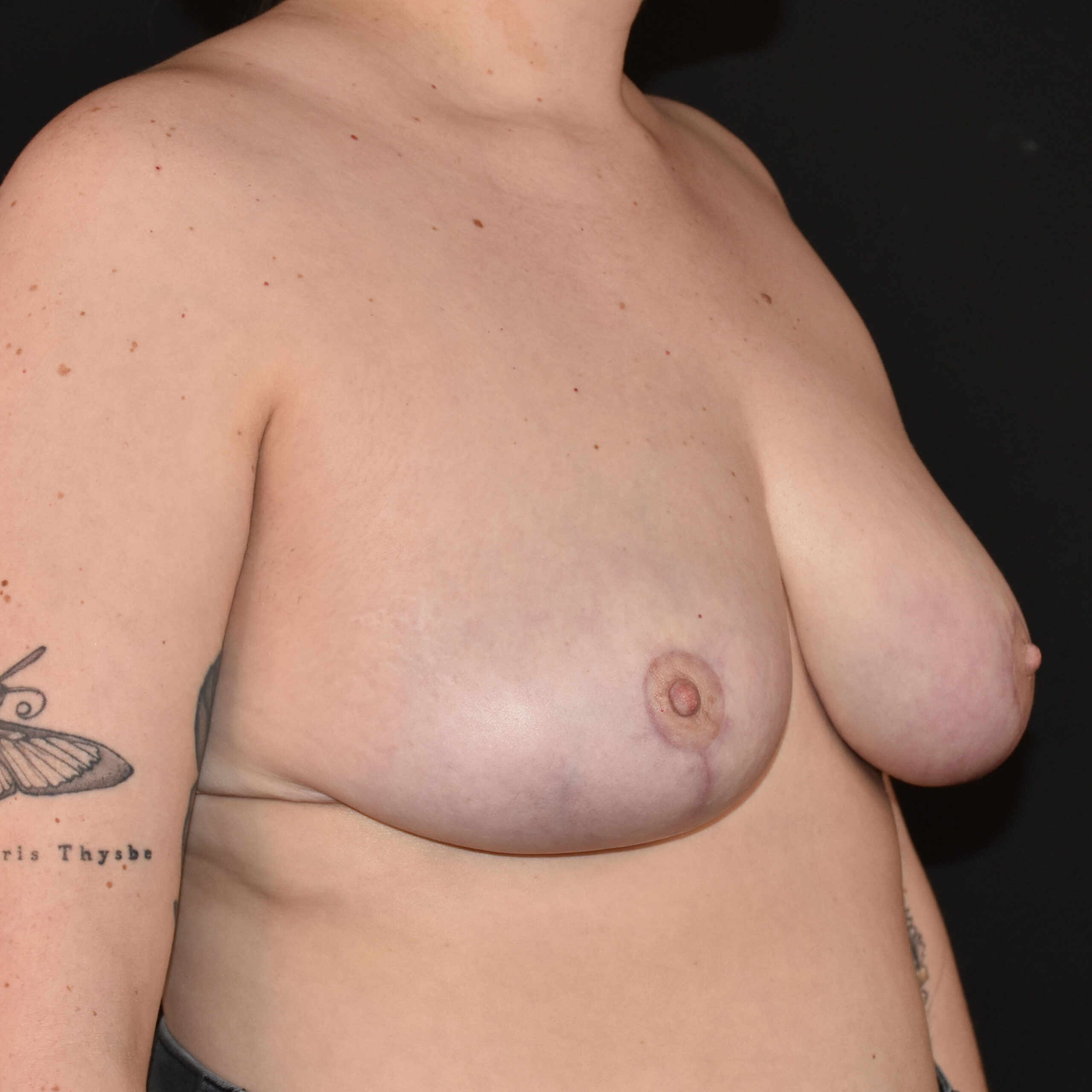 Case--6263 | After Breast Reduction 4